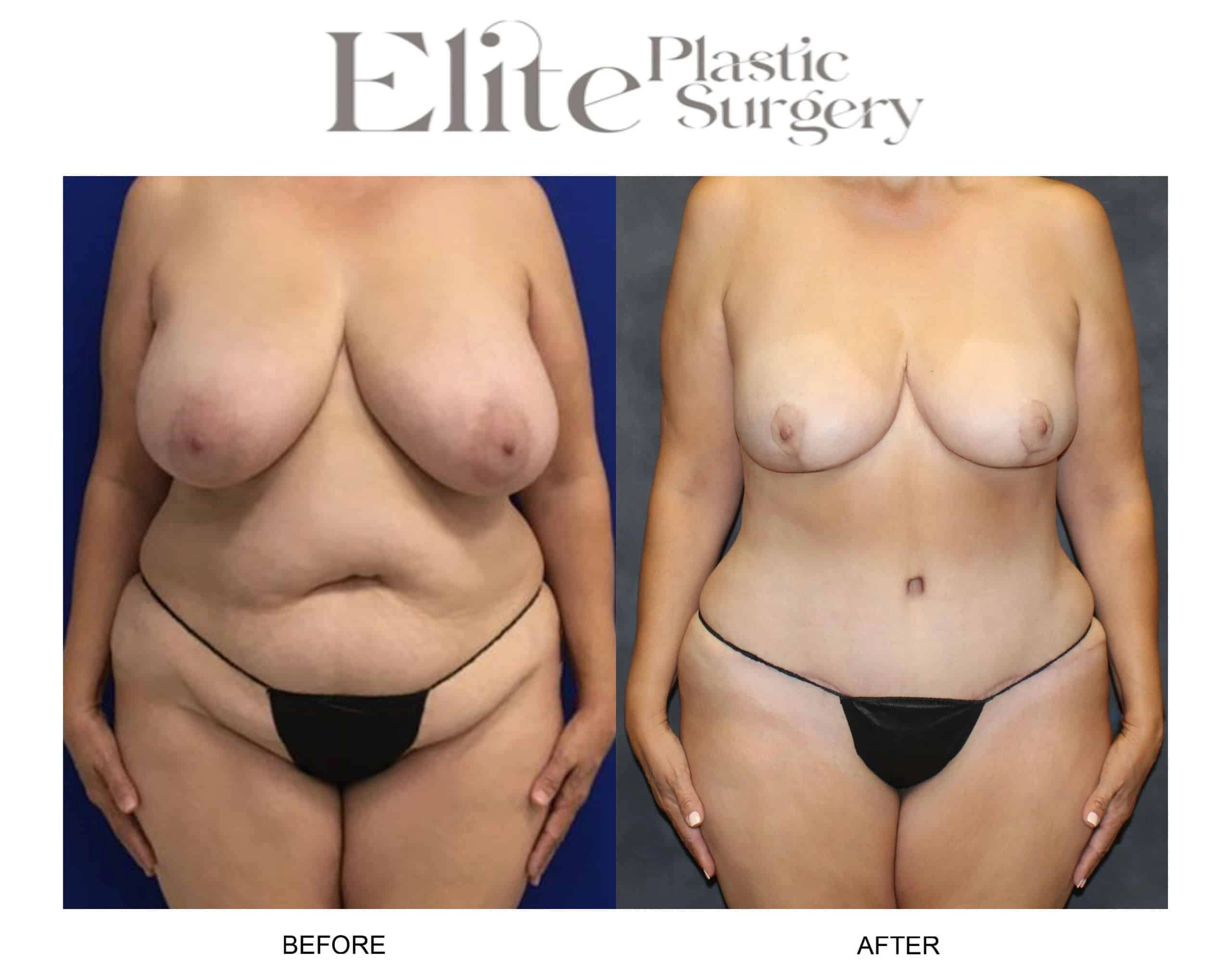 Real patient results before and after plastic surgery results in Arizona, performed by Dr. Torabi