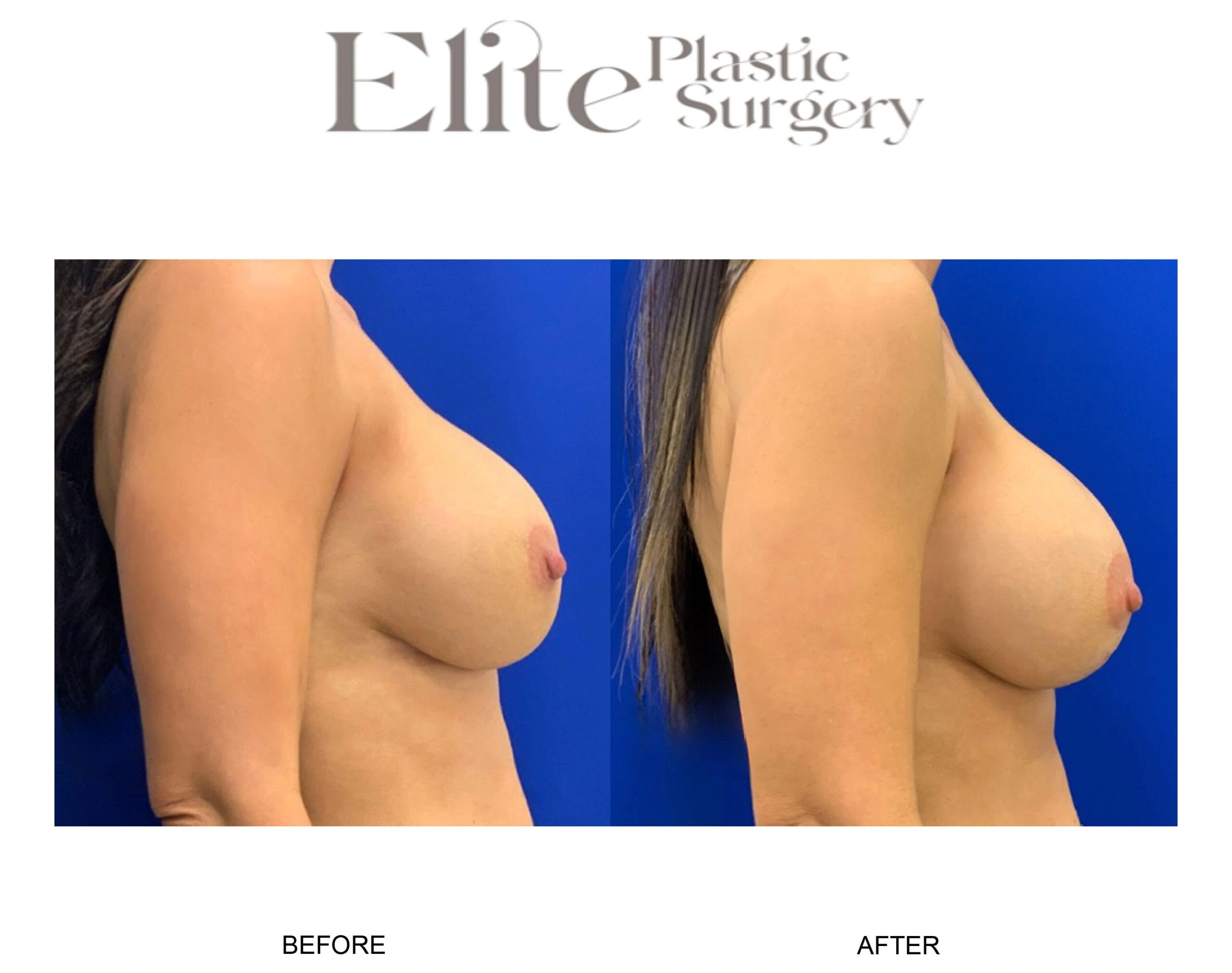 Real patient results before and after plastic surgery results in Arizona, performed by Dr. Torabi