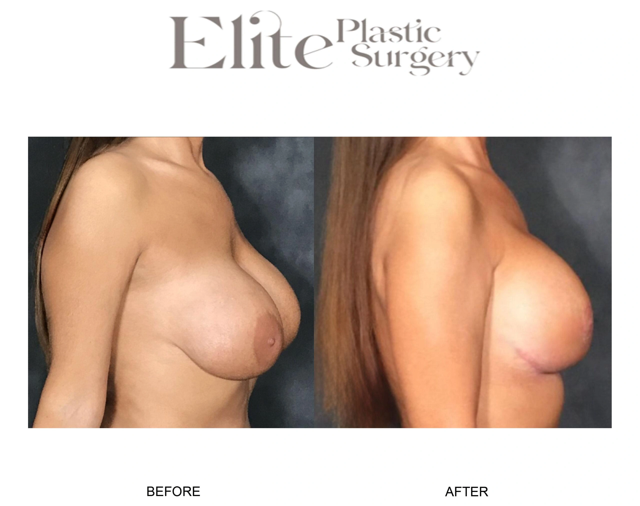 Real patient results before and after plastic surgery results in Arizona, performed by Dr. Torabi