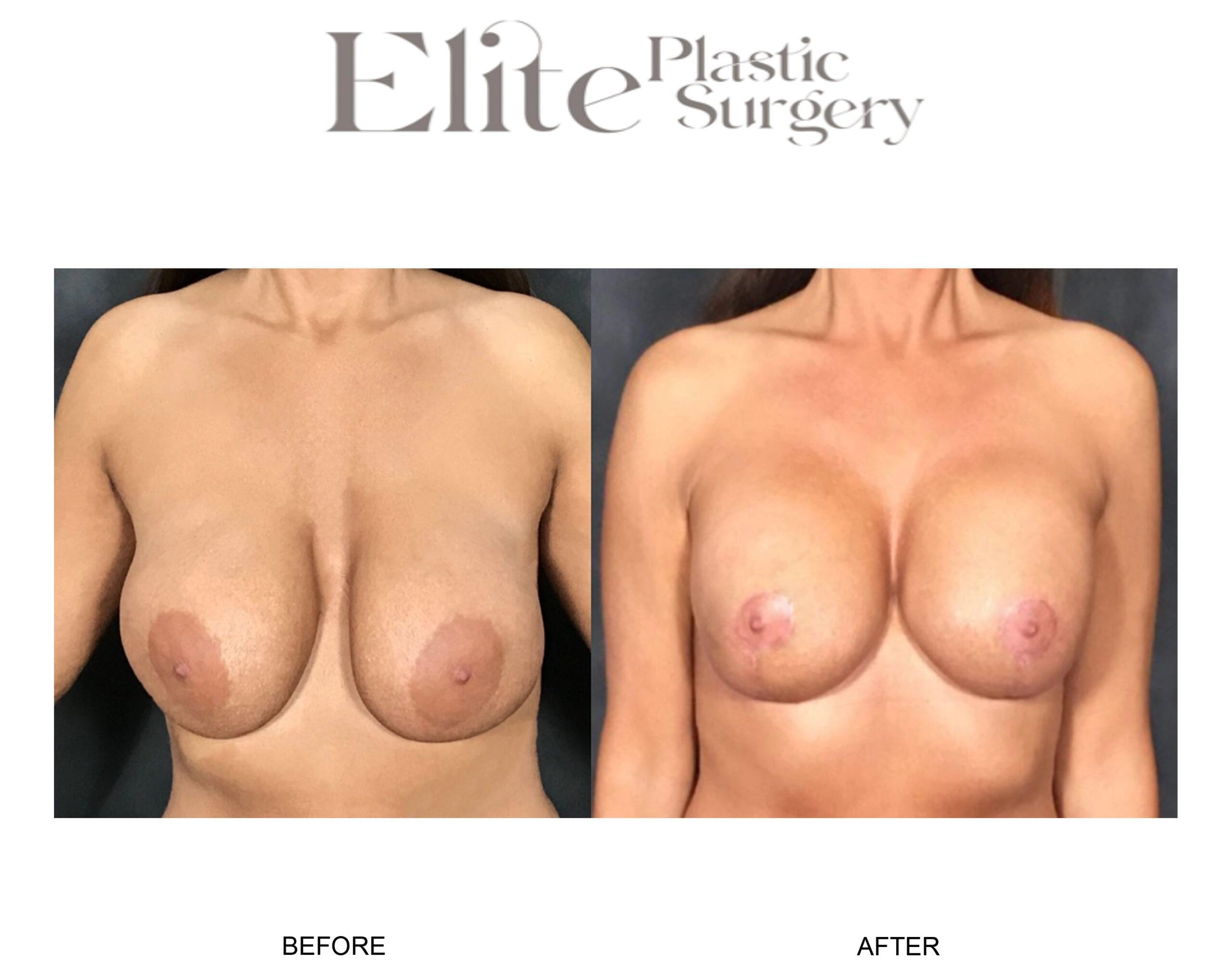 Real patient results before and after plastic surgery results in Arizona, performed by Dr. Torabi