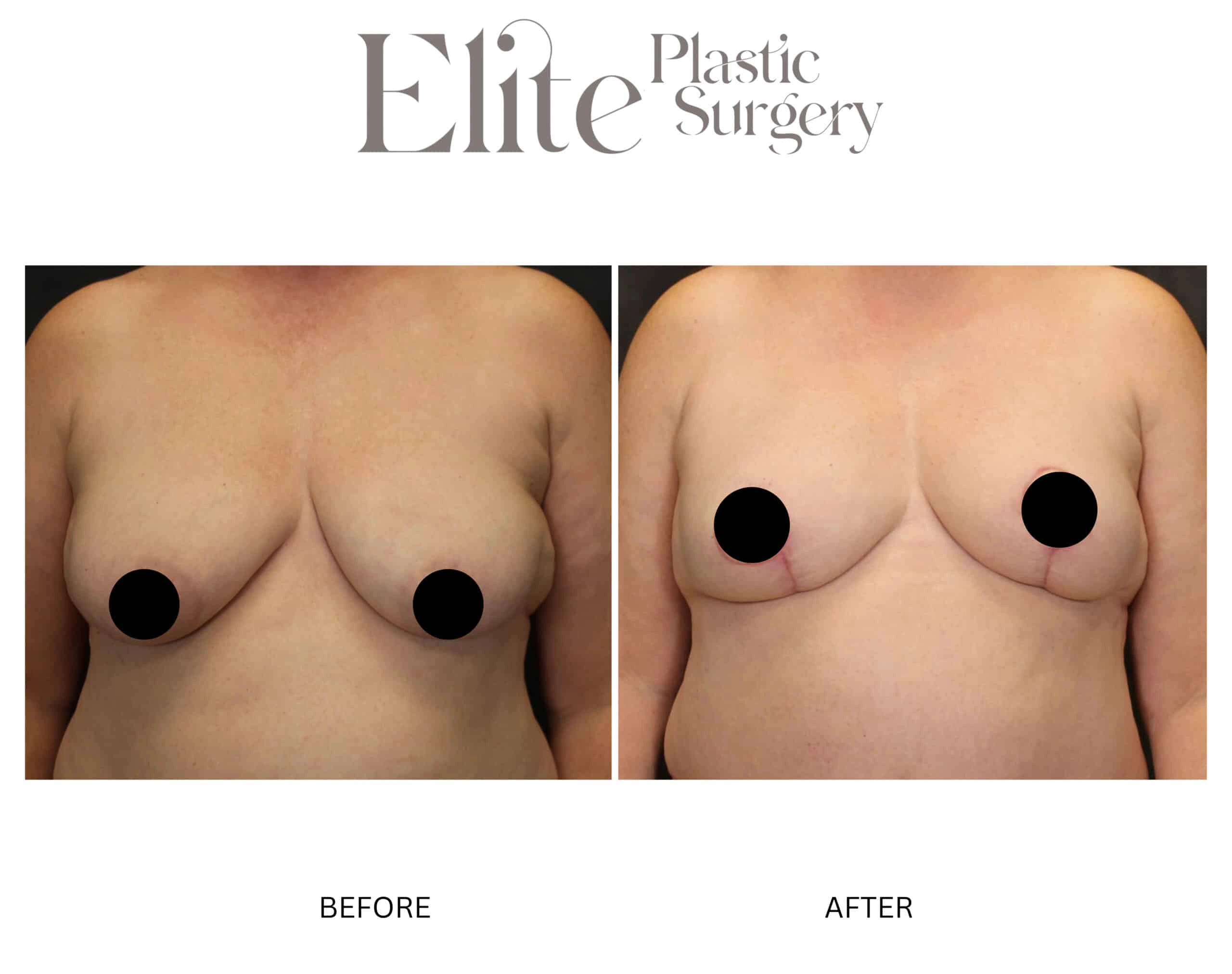 Real patient results before and after plastic surgery results in Arizona, performed by Dr. Torabi