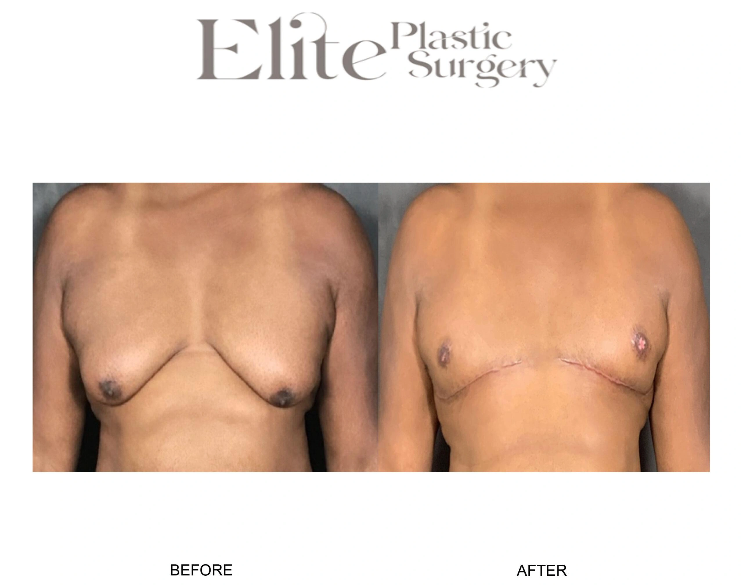 Real patient results before and after plastic surgery results in Arizona, performed by Dr. Torabi
