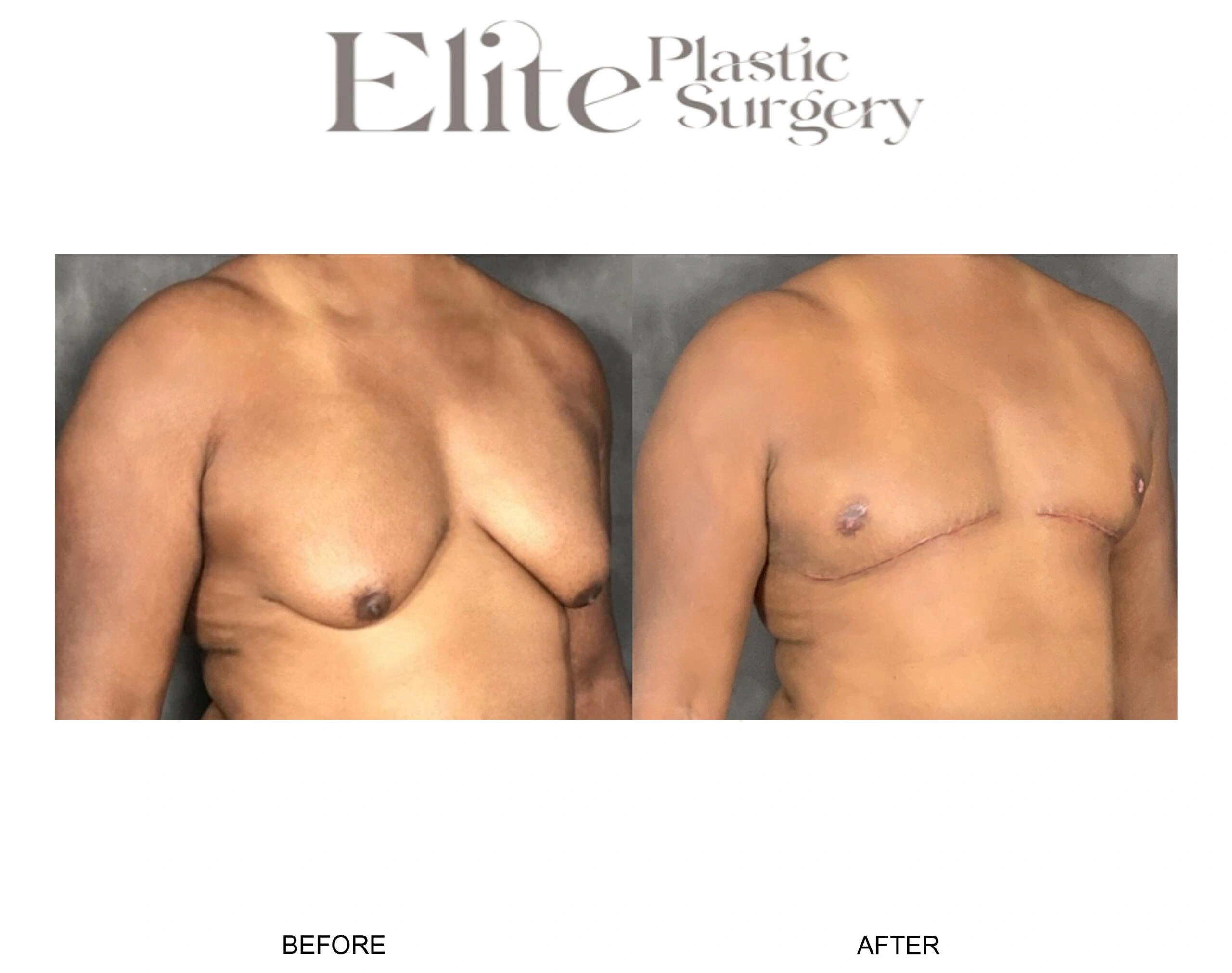 Real patient results before and after plastic surgery results in Arizona, performed by Dr. Torabi