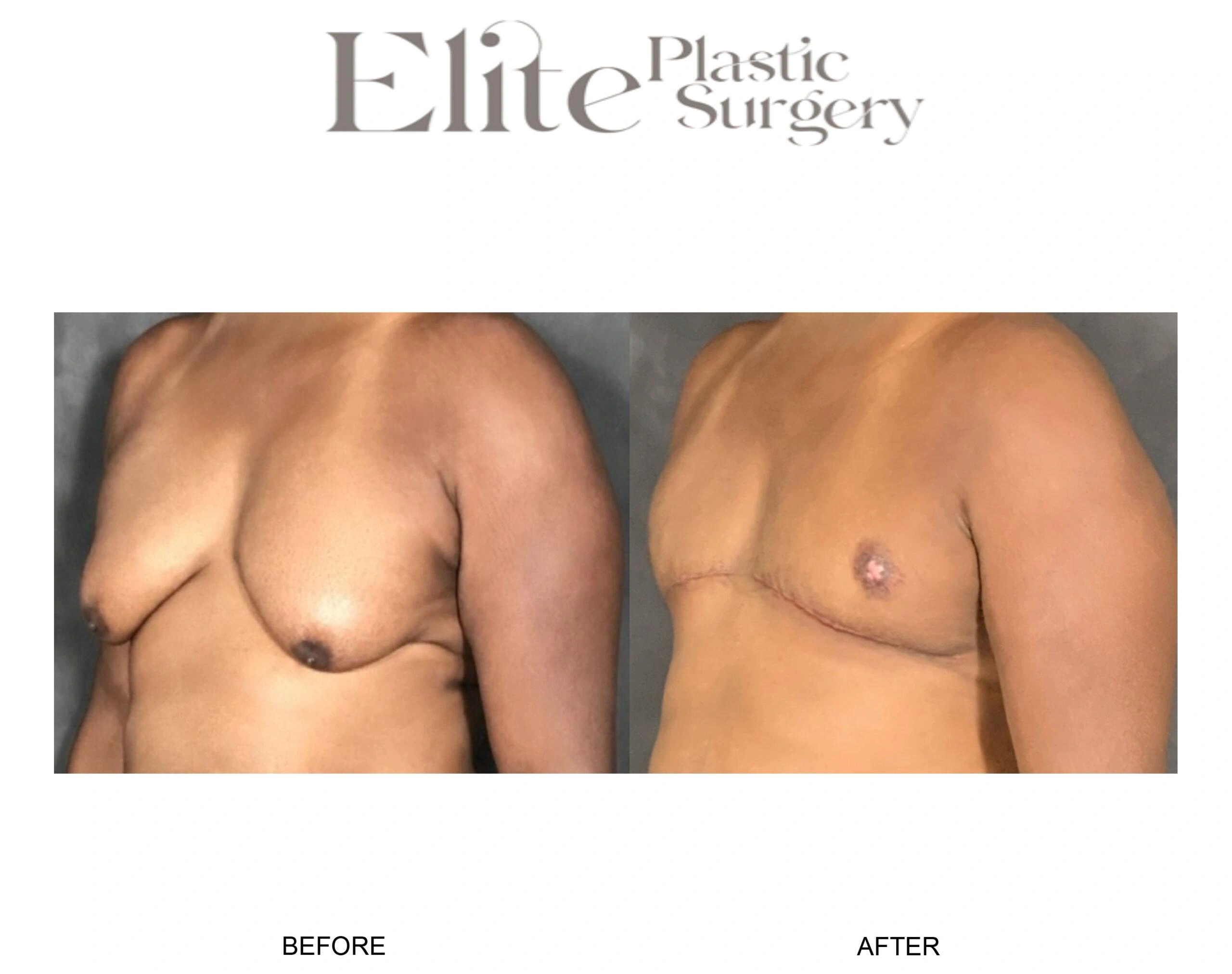 Real patient results before and after plastic surgery results in Arizona, performed by Dr. Torabi