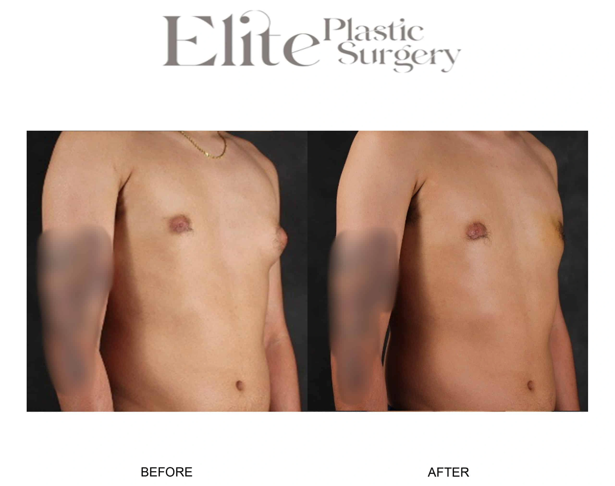 Real patient results before and after plastic surgery results in Arizona, performed by Dr. Torabi