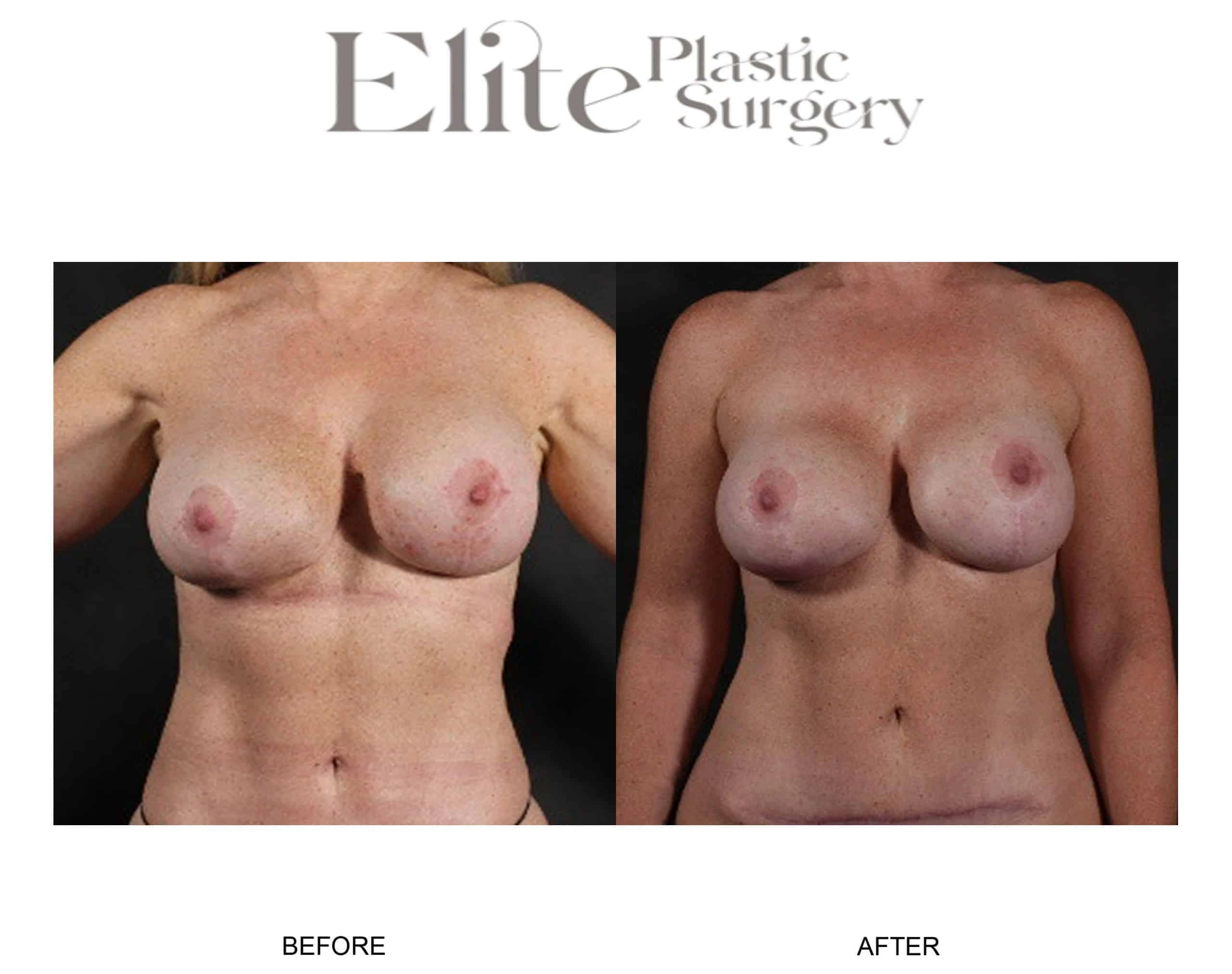Real patient results before and after plastic surgery results in Arizona, performed by Dr. Torabi