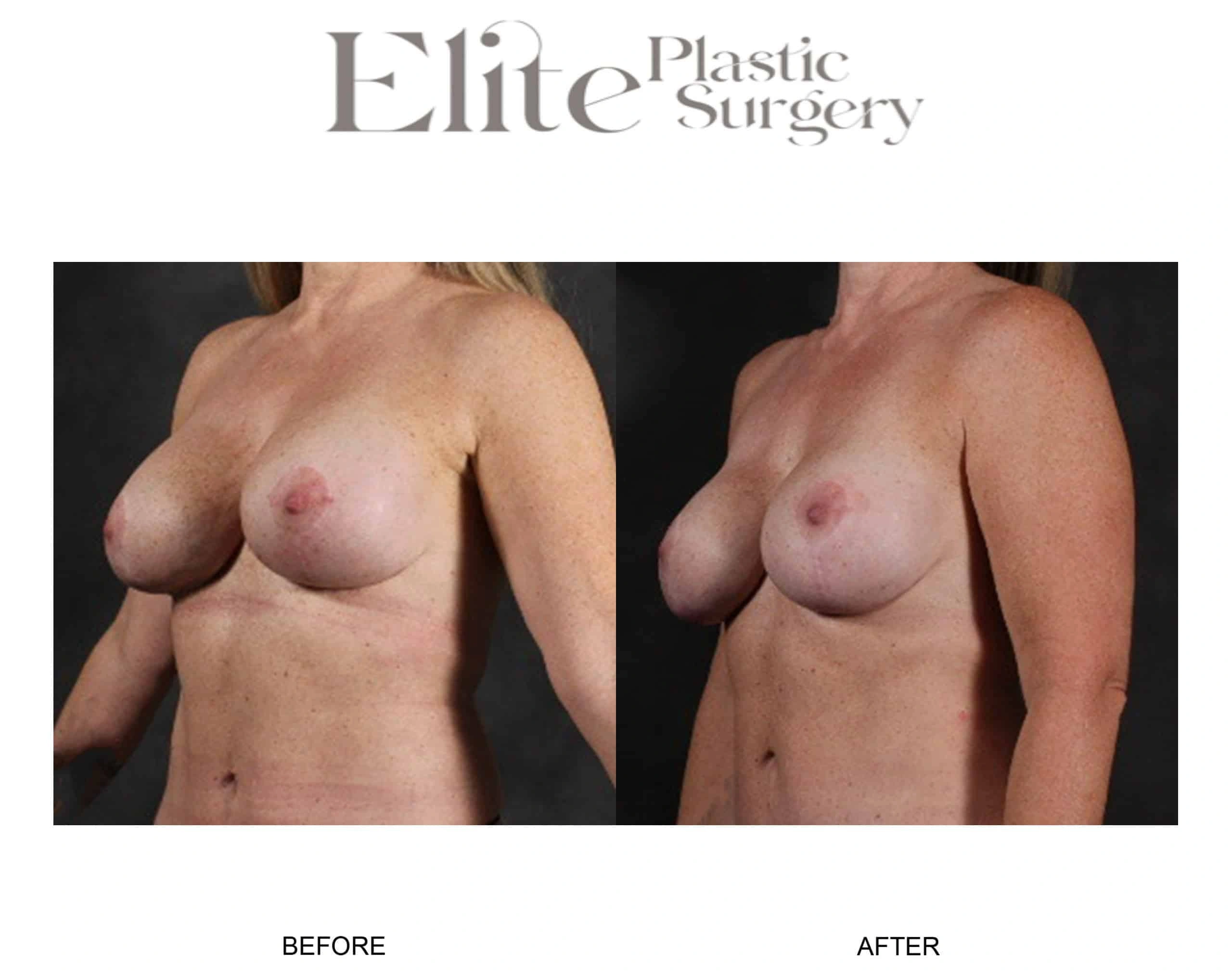 Real patient results before and after plastic surgery results in Arizona, performed by Dr. Torabi