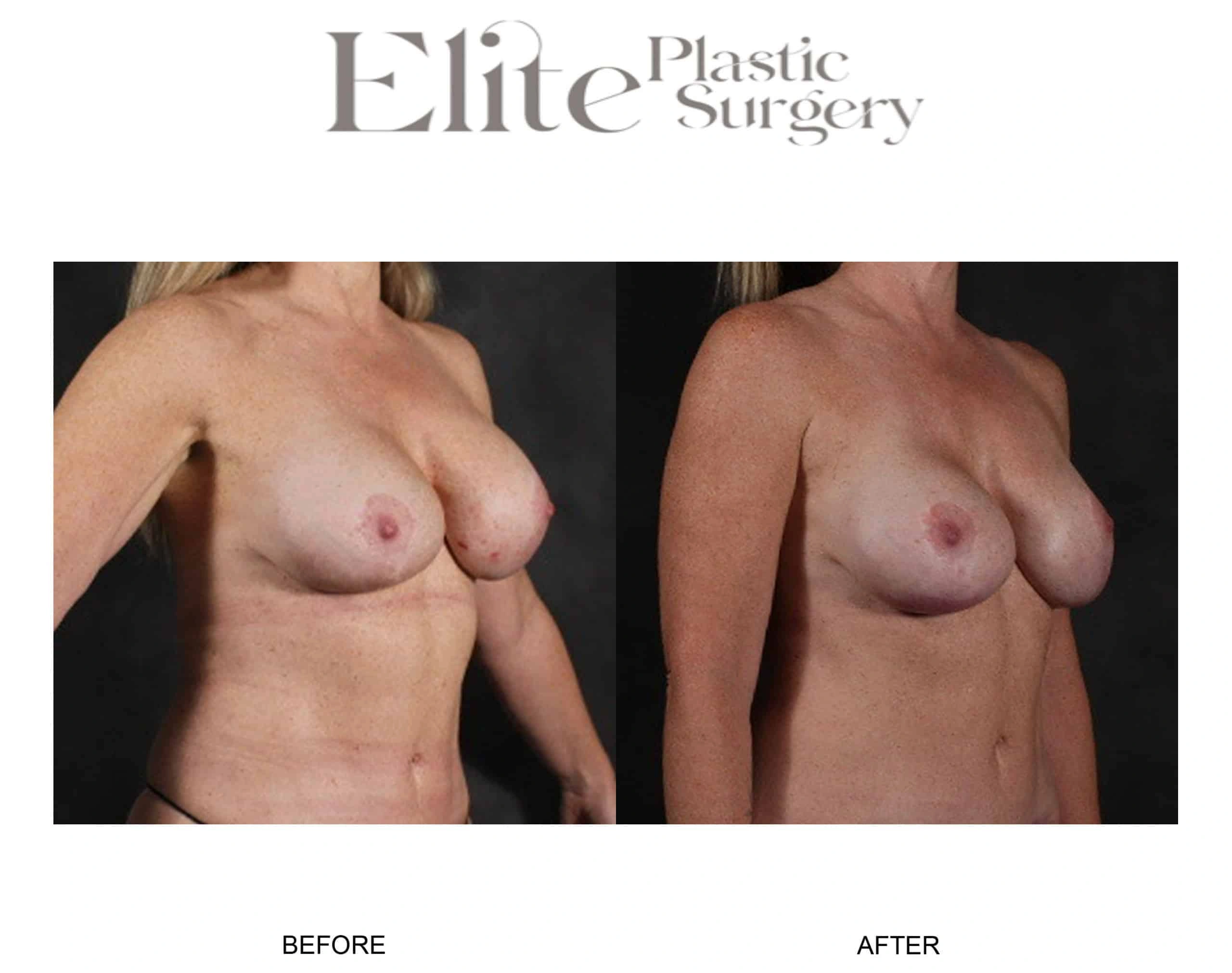 Real patient results before and after plastic surgery results in Arizona, performed by Dr. Torabi