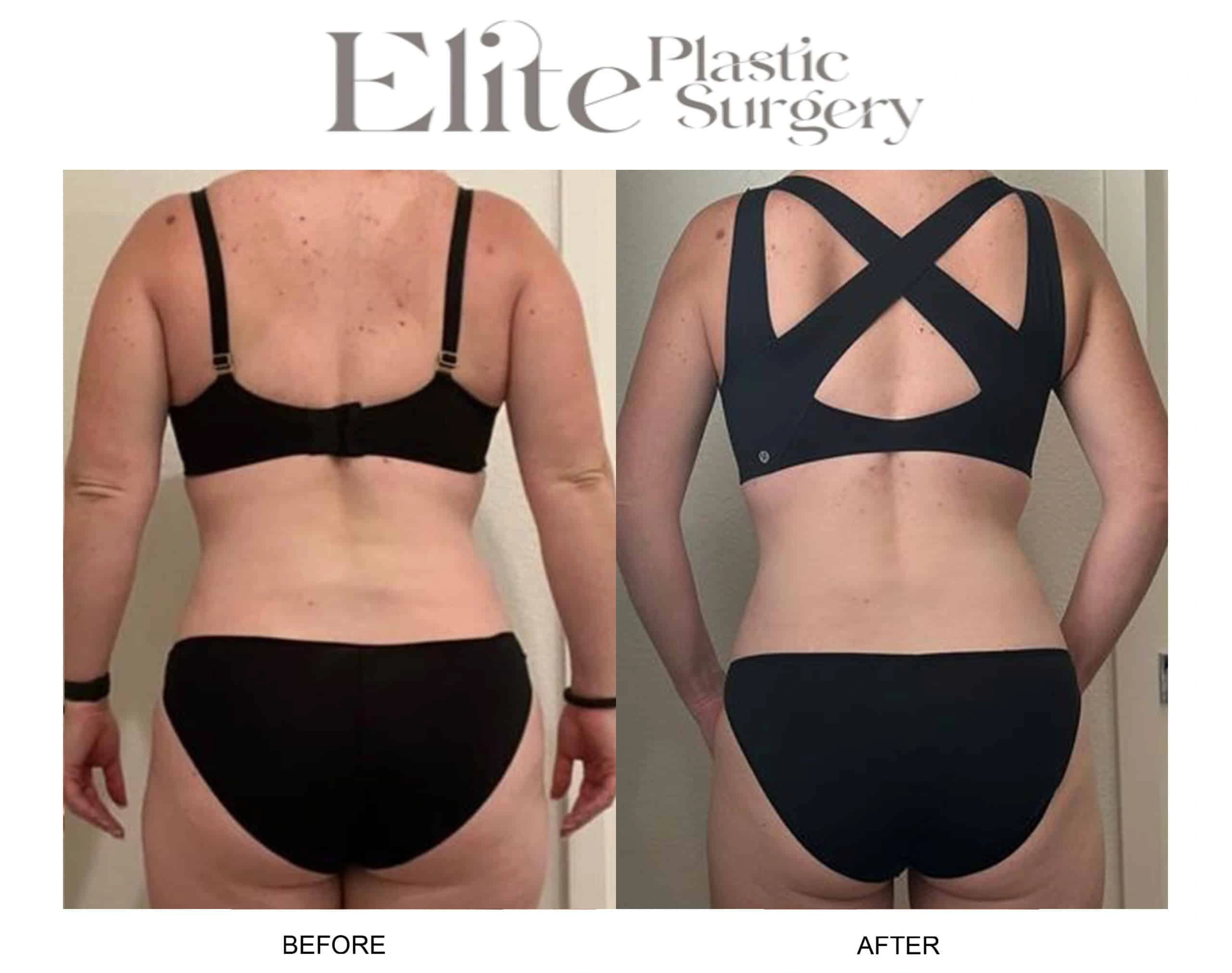 Real patient results before and after plastic surgery results in Arizona, performed by Dr. Torabi