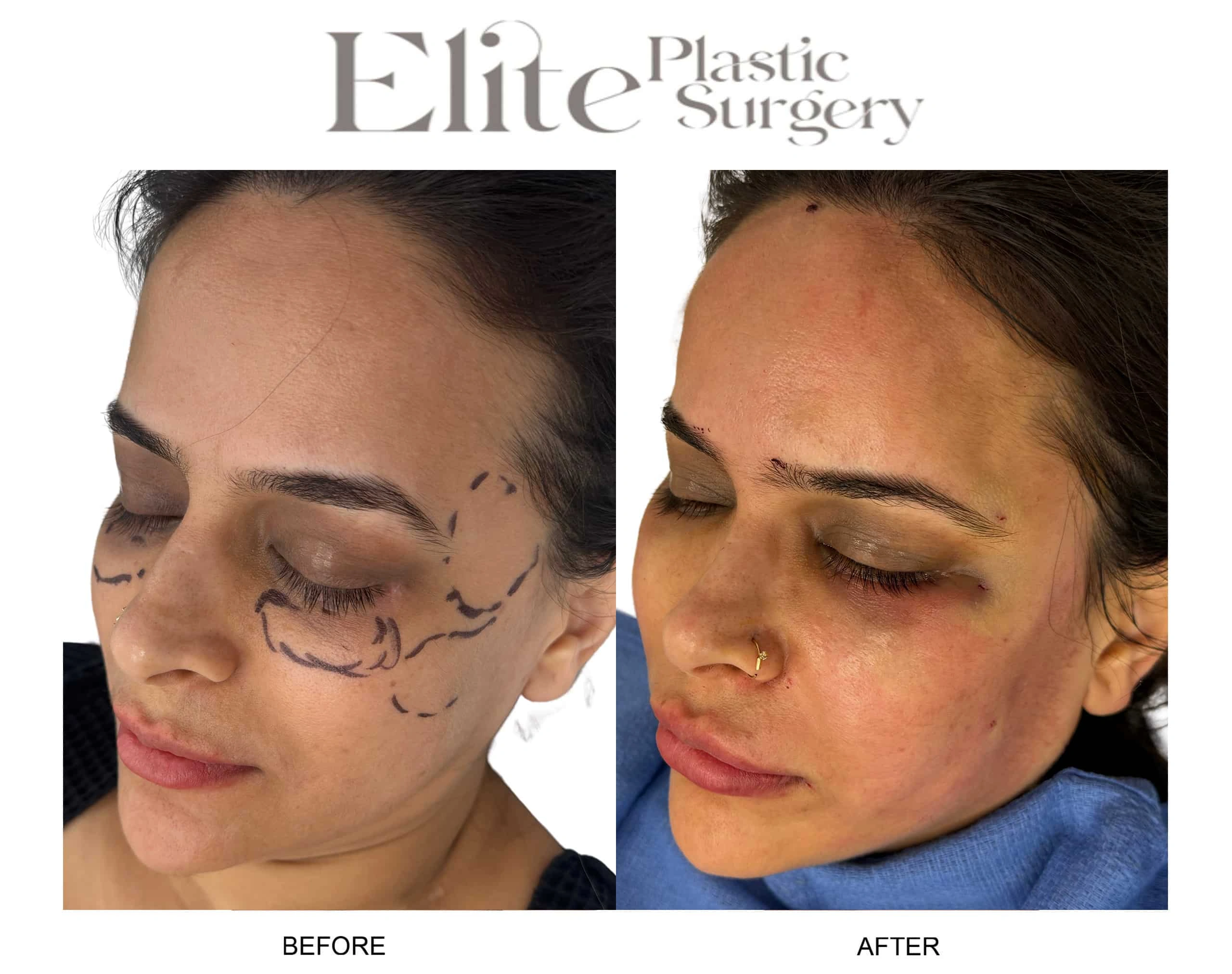 Real patient results before and after plastic surgery results in Arizona, performed by Dr. Torabi