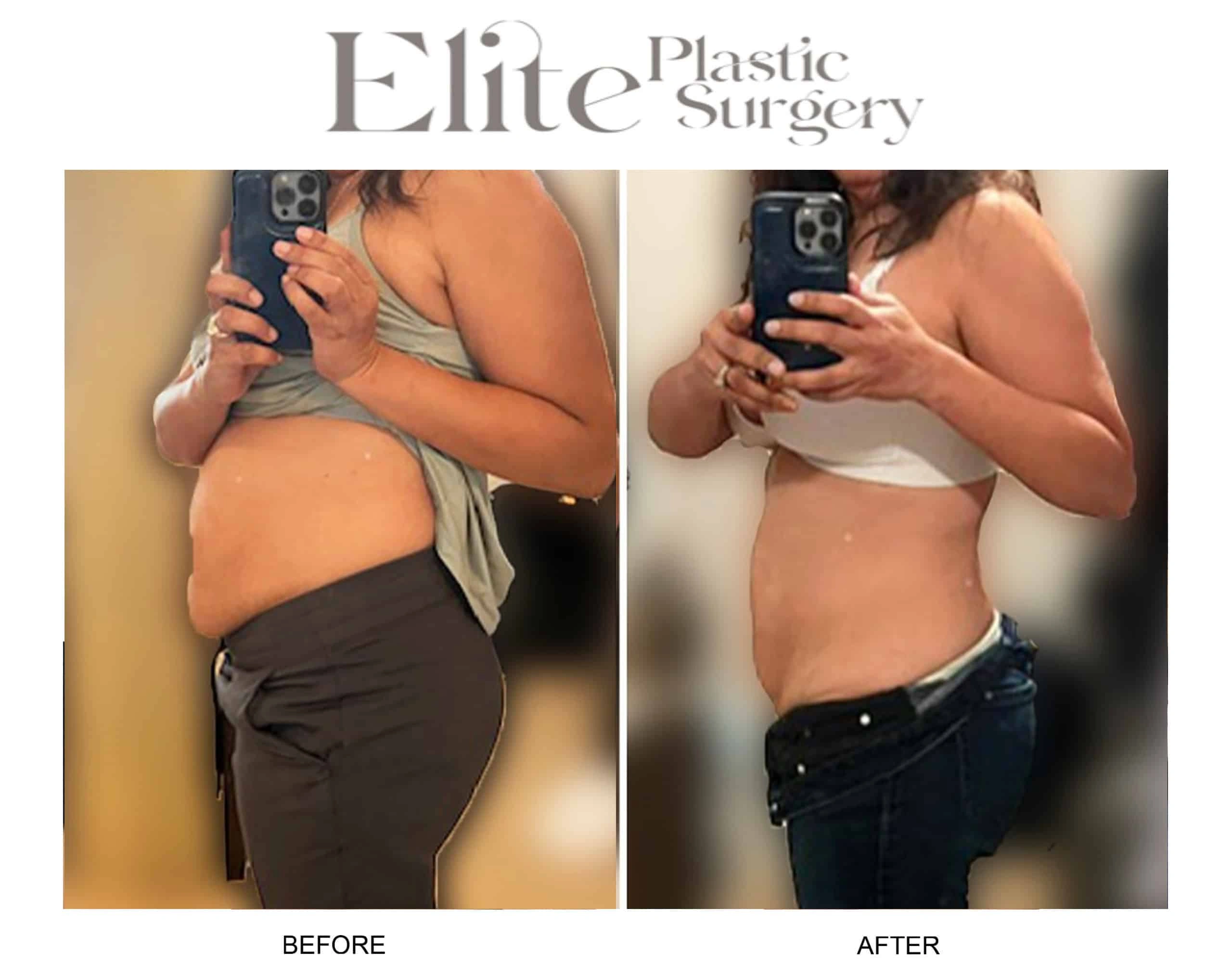 Real patient results before and after plastic surgery results in Arizona, performed by Dr. Torabi