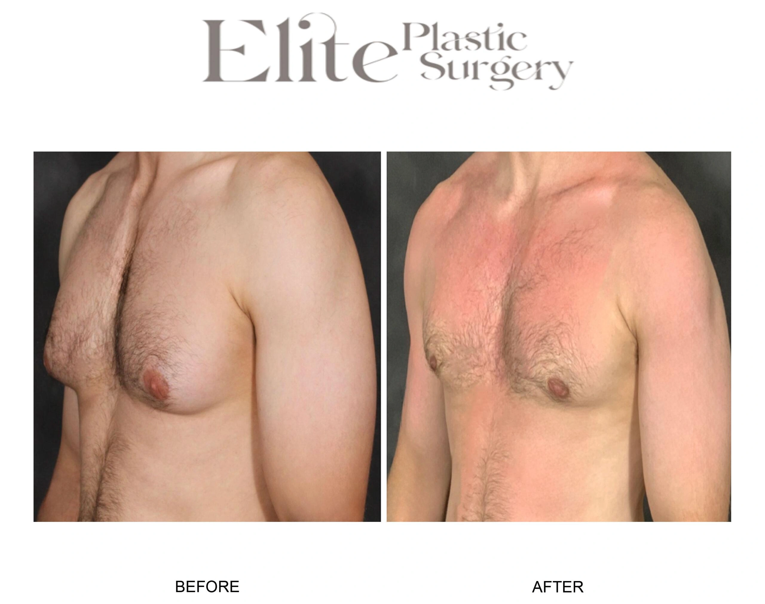 Real patient results before and after plastic surgery results in Arizona, performed by Dr. Torabi
