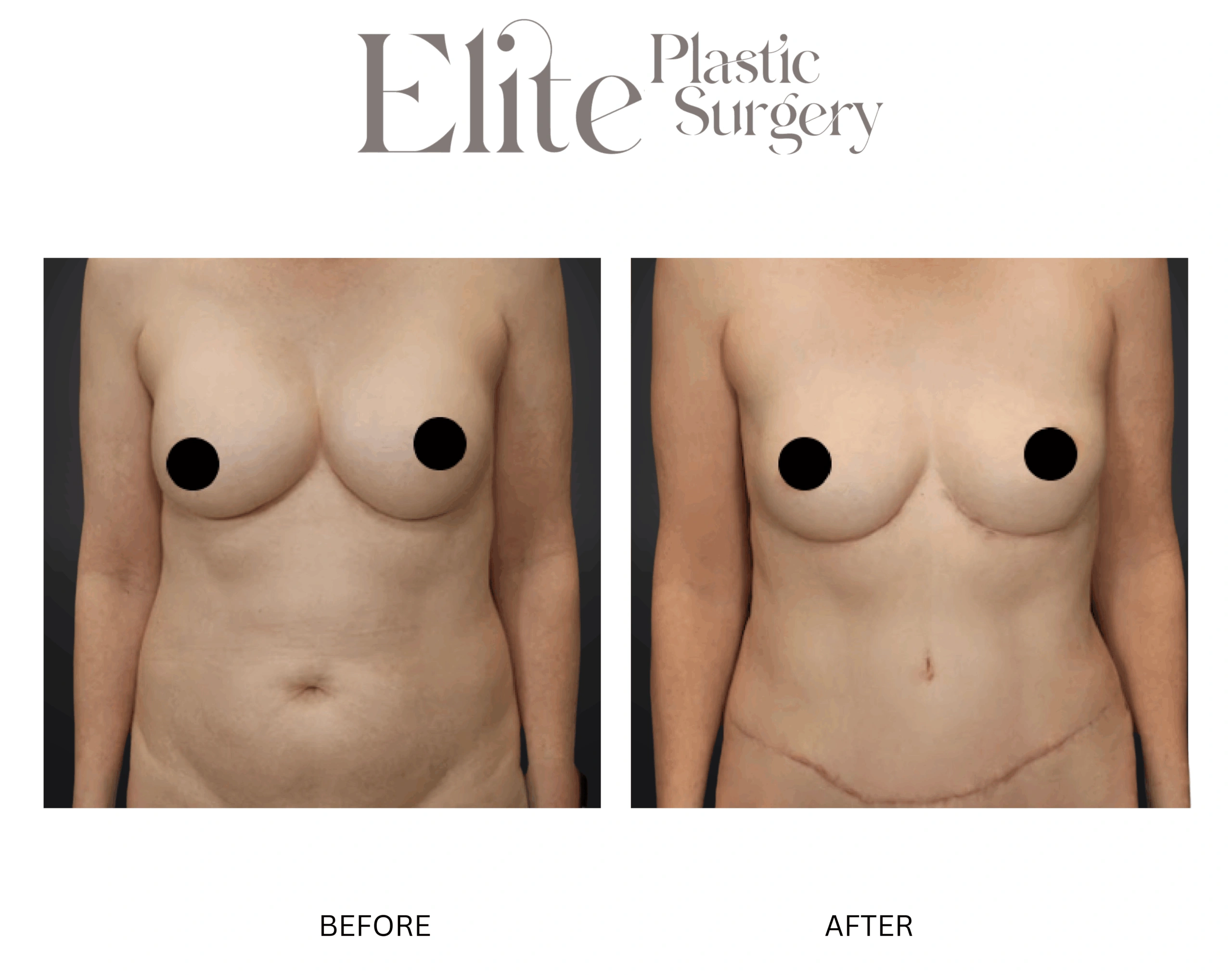Real patient results before and after plastic surgery results in Arizona, performed by Dr. Torabi