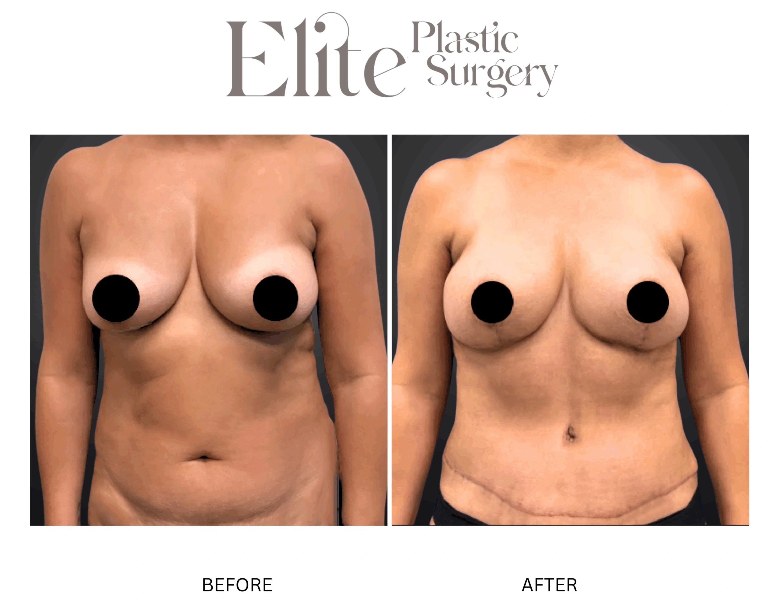Real patient results before and after plastic surgery results in Arizona, performed by Dr. Torabi