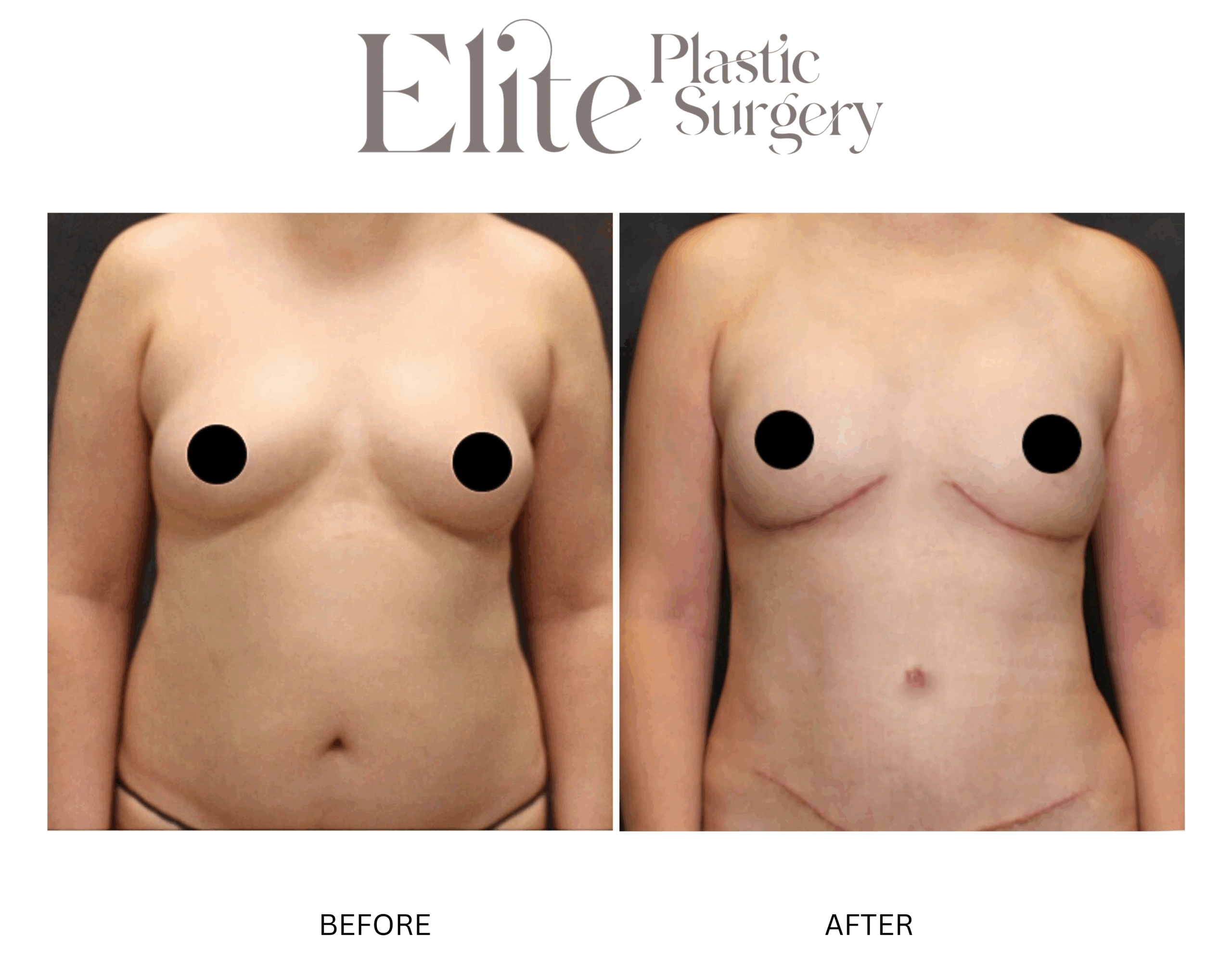 Real patient results before and after plastic surgery results in Arizona, performed by Dr. Torabi