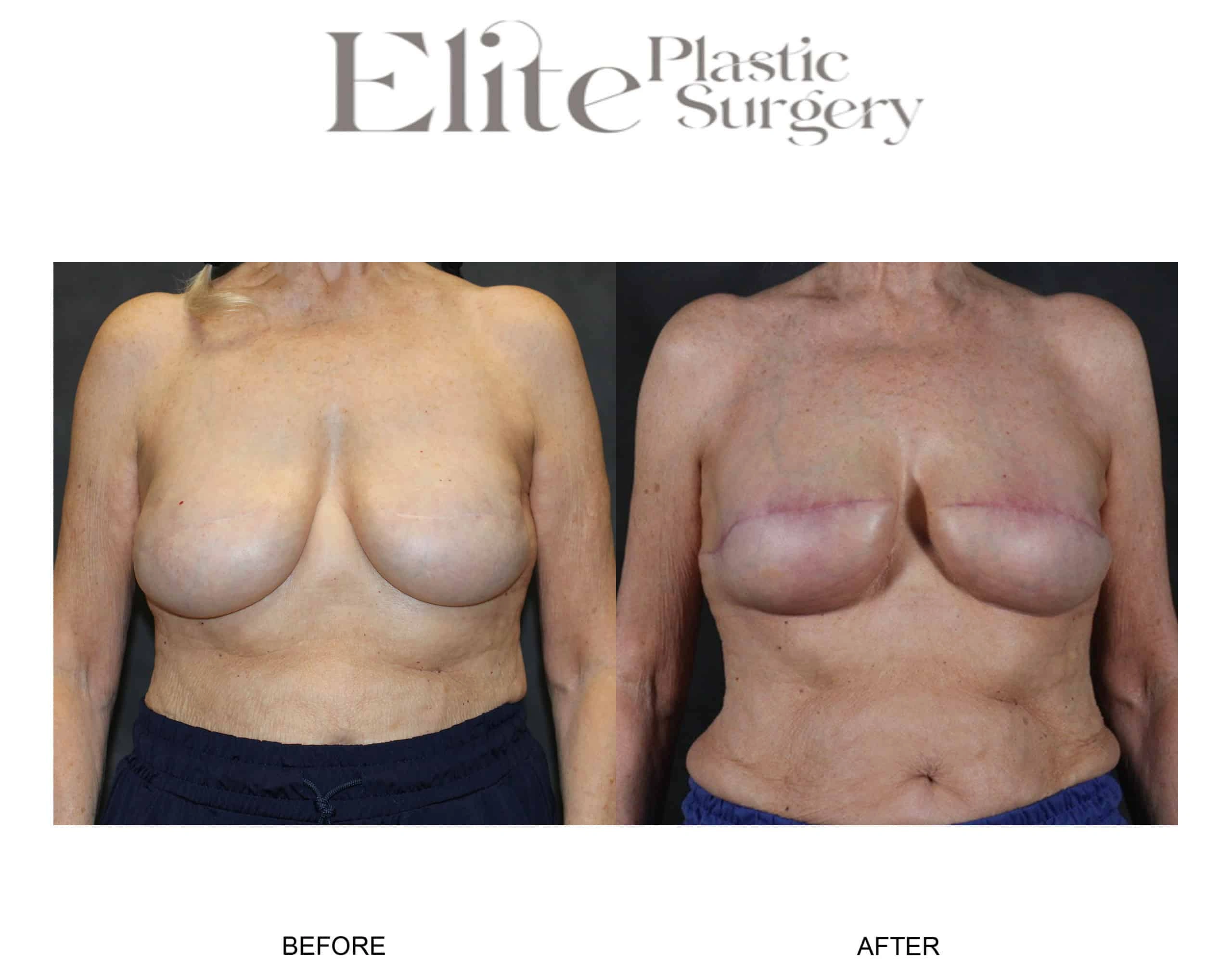 Real patient results before and after plastic surgery results in Arizona, performed by Dr. Torabi