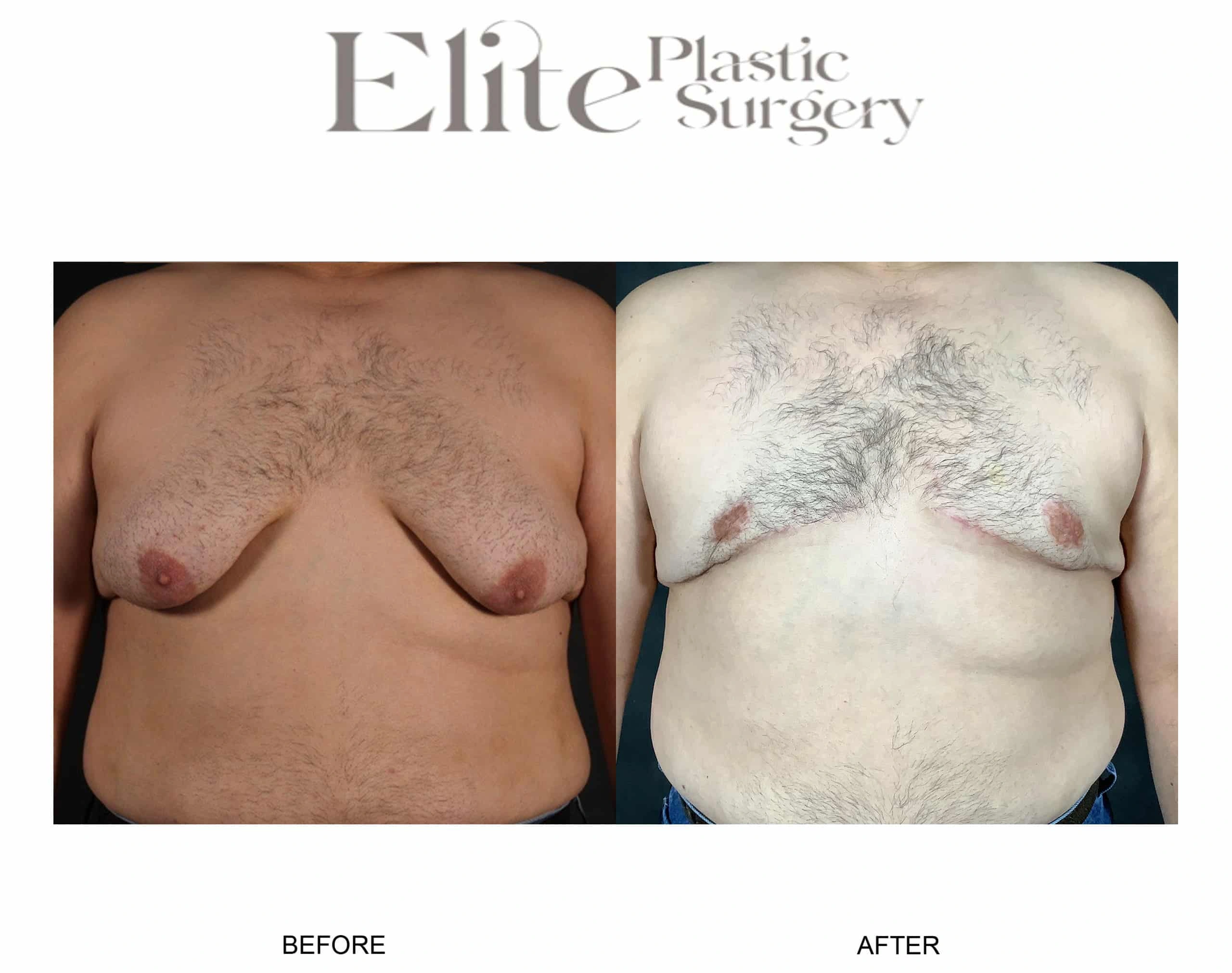 Real patient results before and after plastic surgery results in Arizona, performed by Dr. Torabi