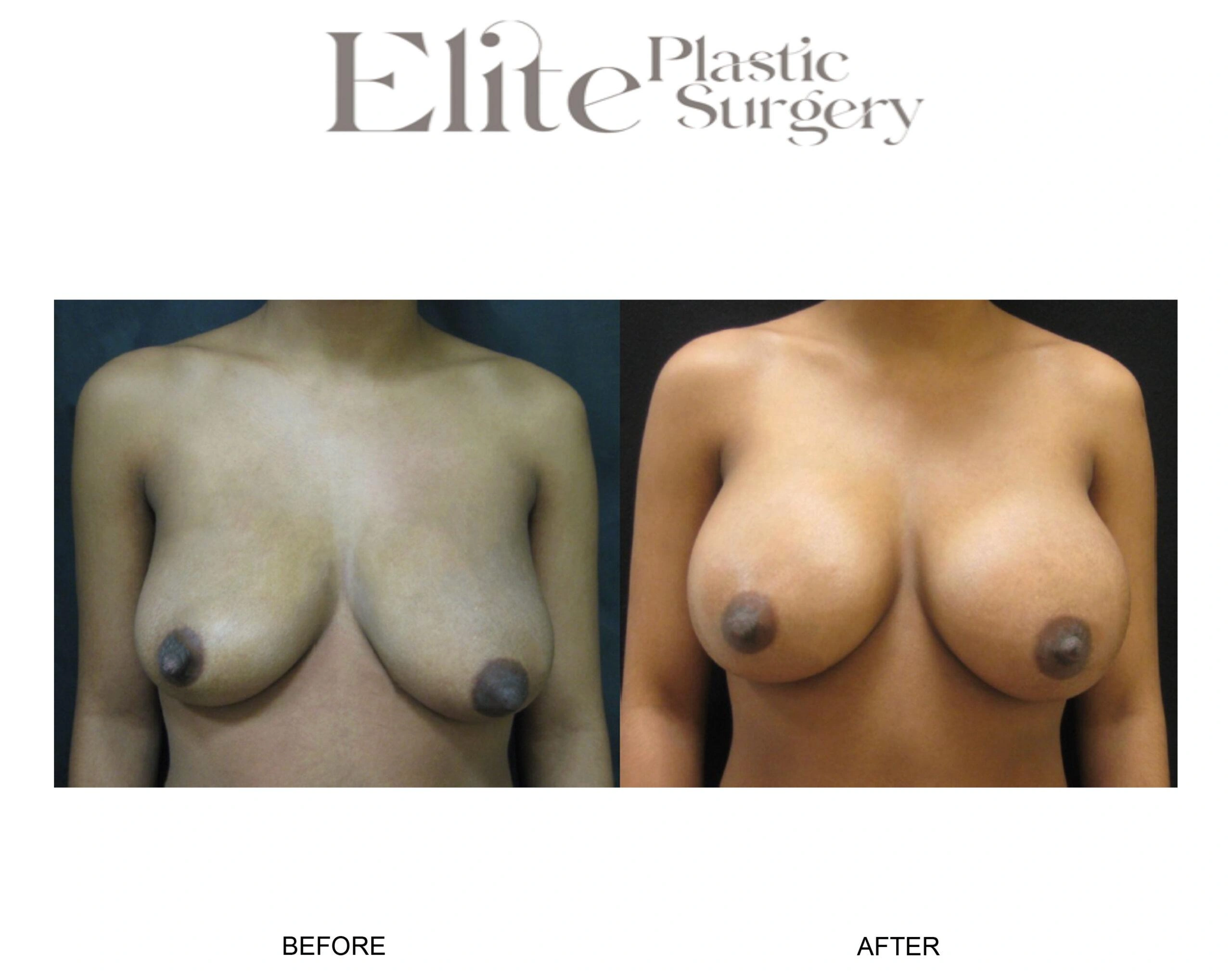 Real patient results before and after plastic surgery results in Arizona, performed by Dr. Torabi