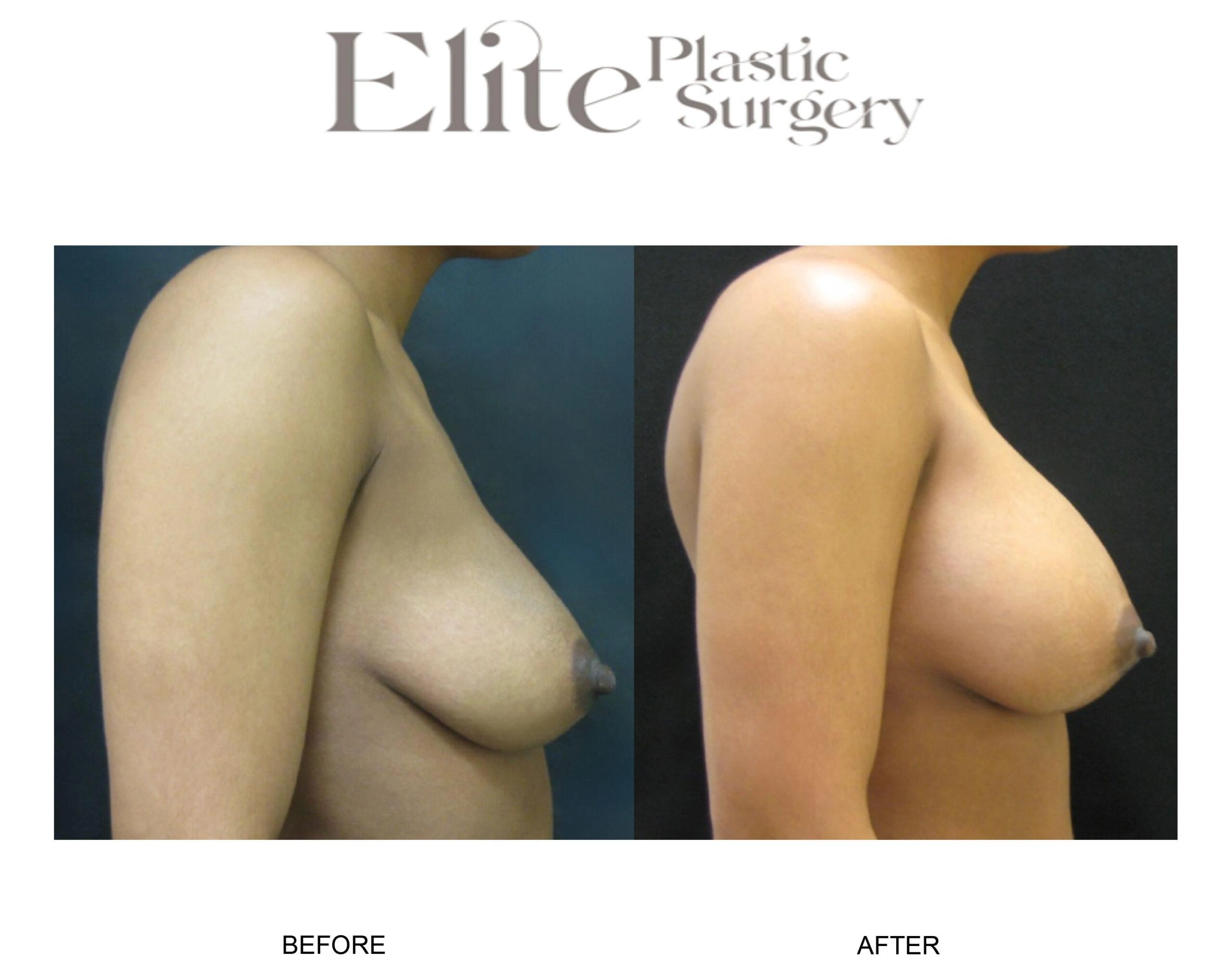 Real patient results before and after plastic surgery results in Arizona, performed by Dr. Torabi