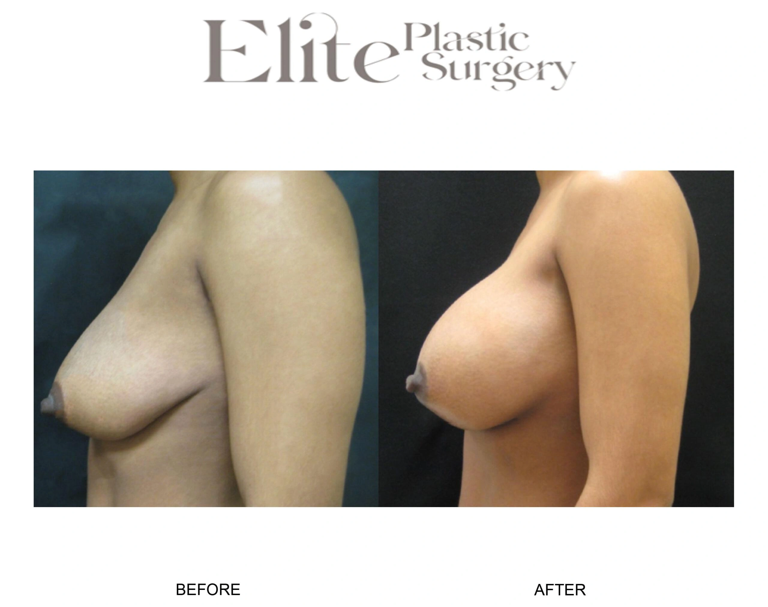 Real patient results before and after plastic surgery results in Arizona, performed by Dr. Torabi