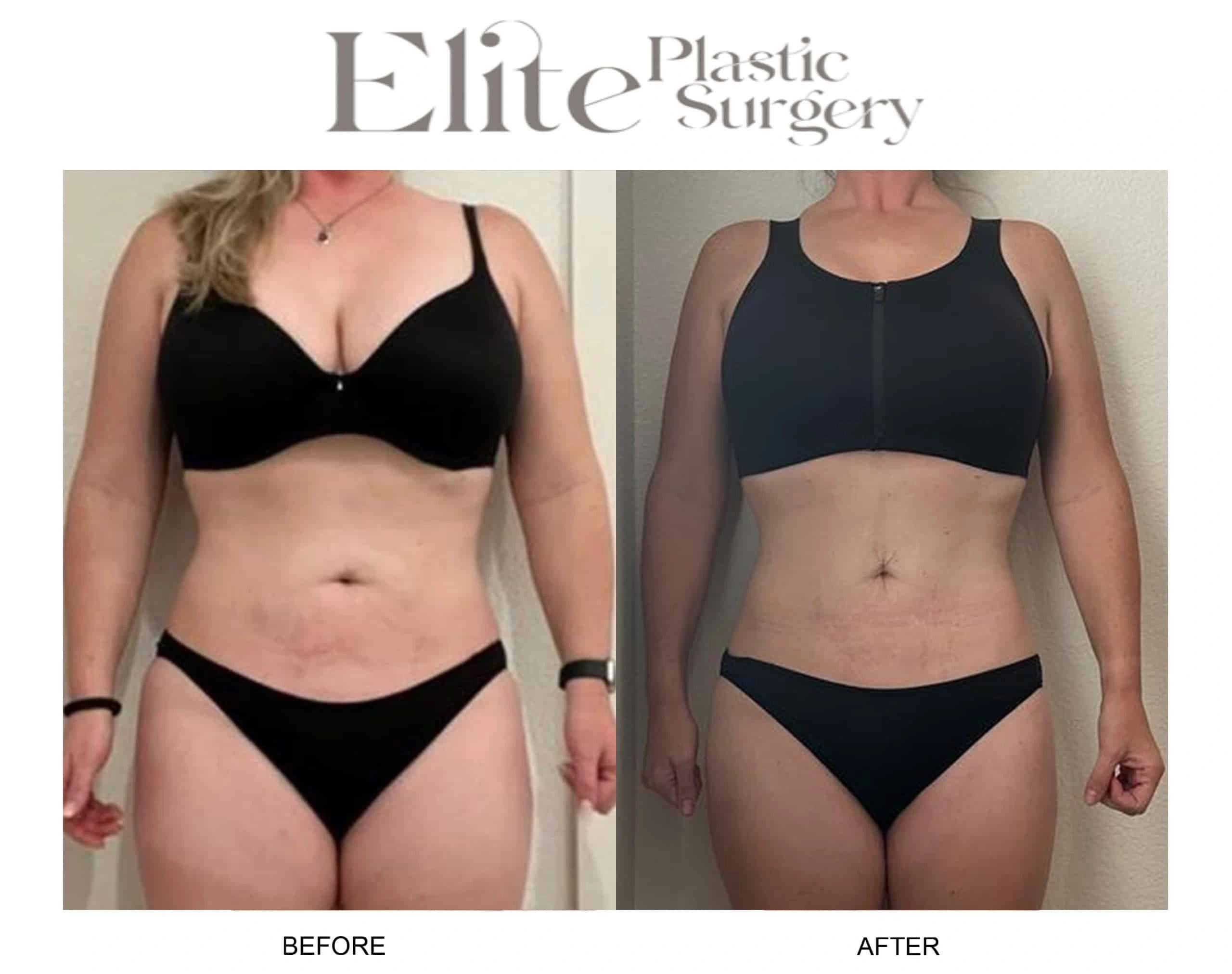 Real patient results before and after plastic surgery results in Arizona, performed by Dr. Torabi