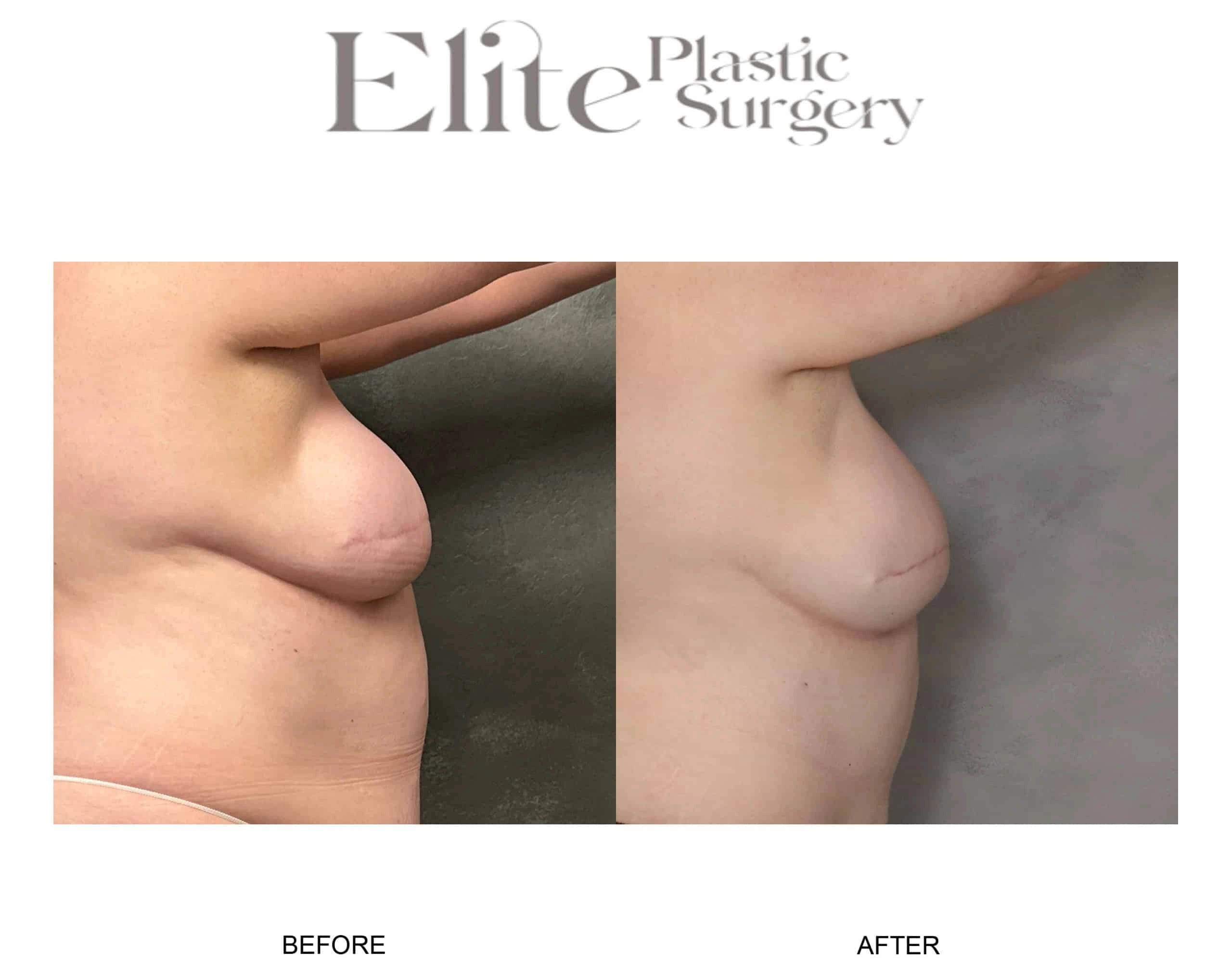 Real patient results before and after plastic surgery results in Arizona, performed by Dr. Torabi