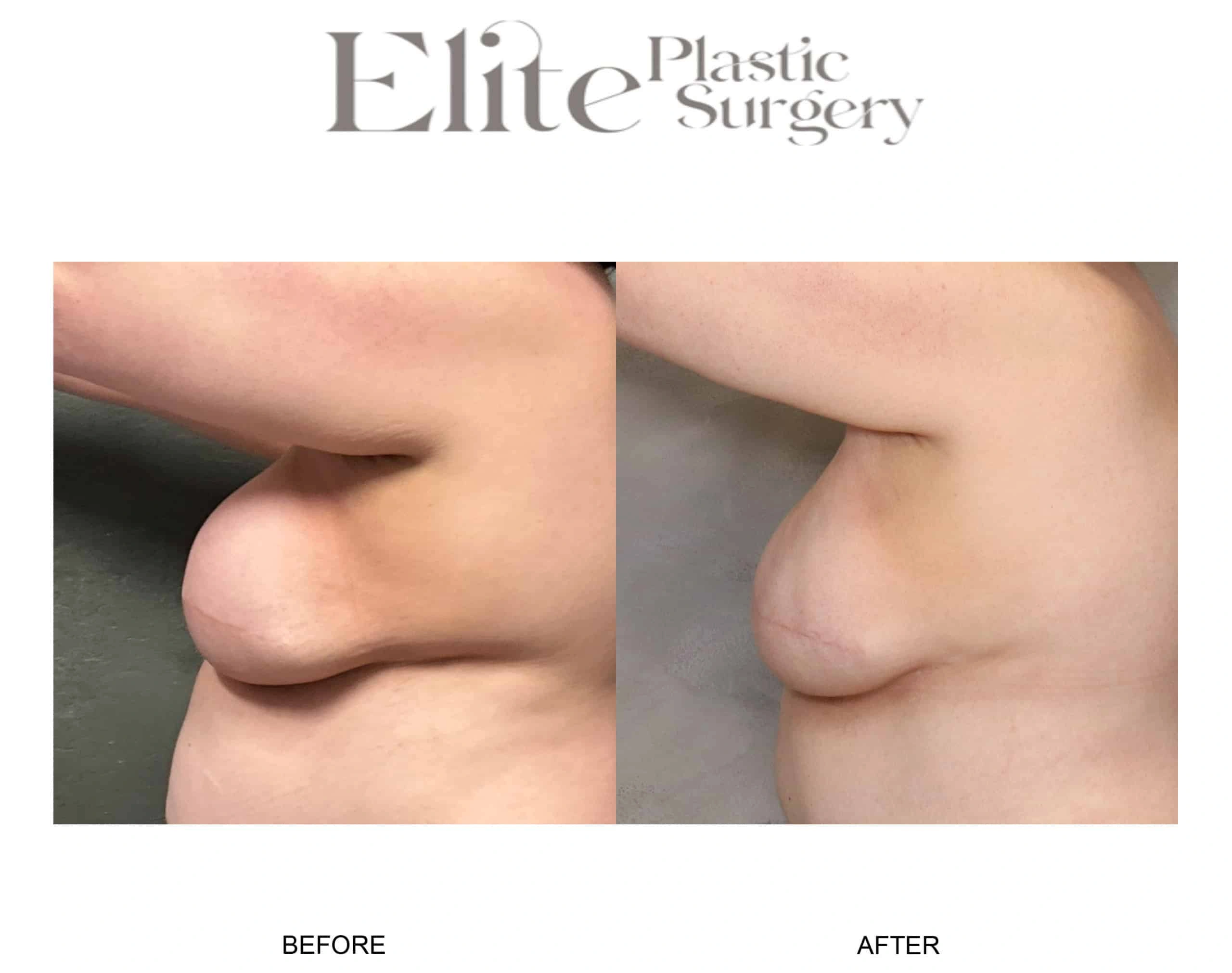 Real patient results before and after plastic surgery results in Arizona, performed by Dr. Torabi