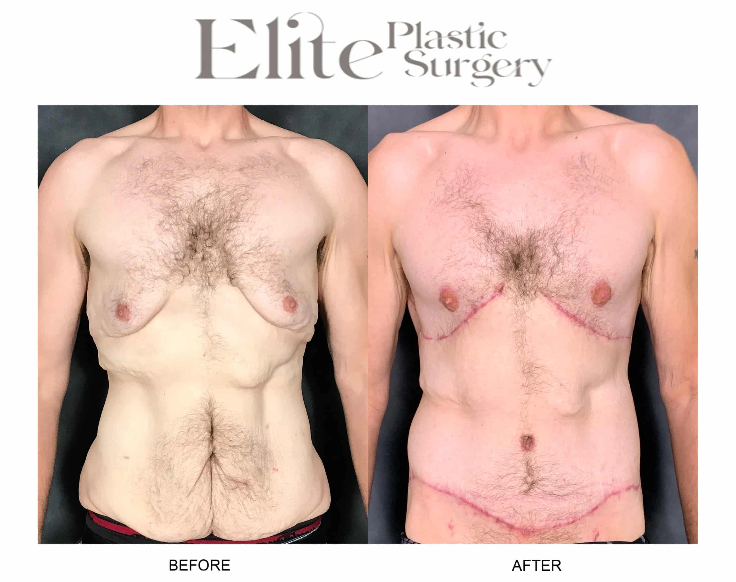 Real patient results before and after plastic surgery results in Arizona, performed by Dr. Torabi