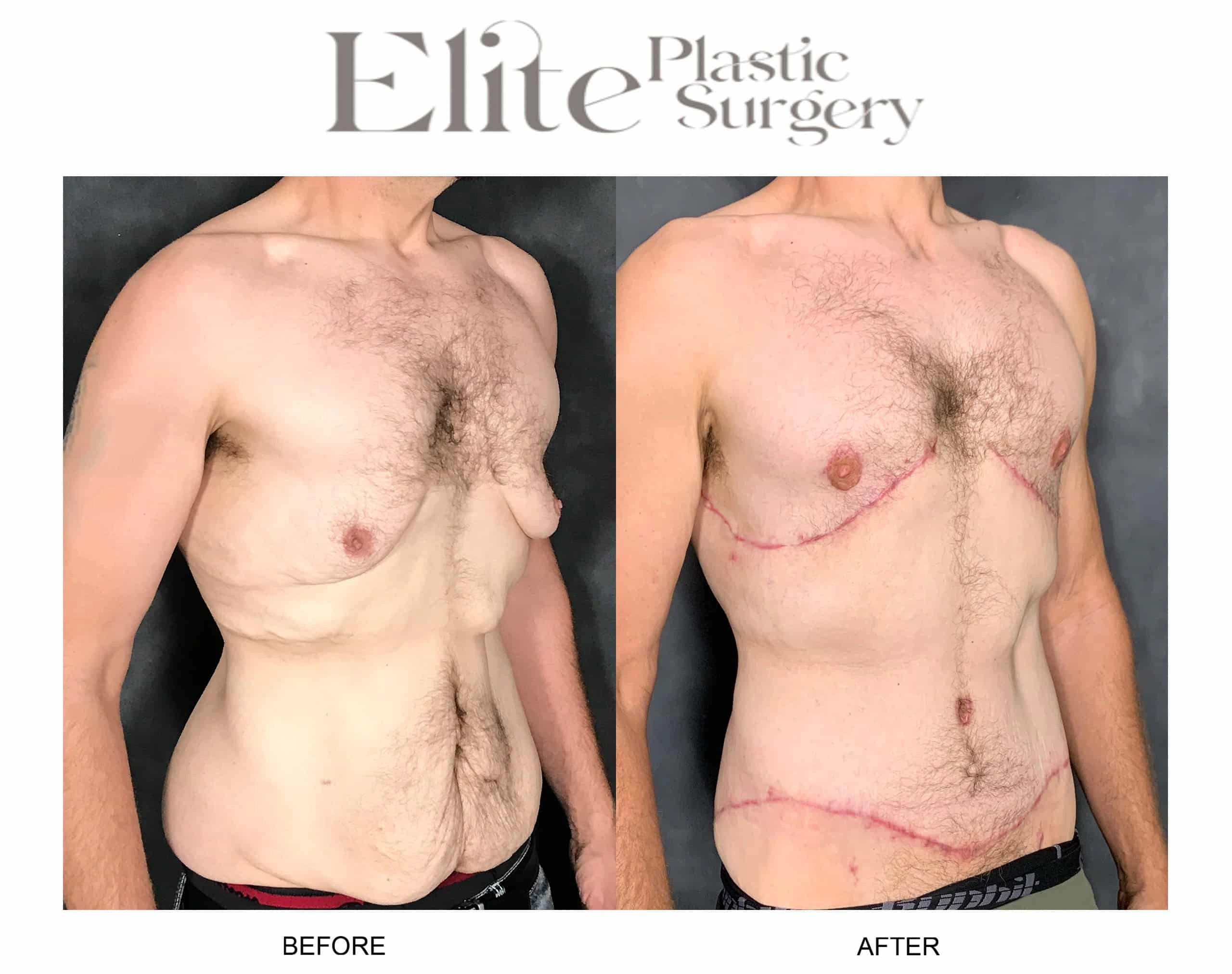 Real patient results before and after plastic surgery results in Arizona, performed by Dr. Torabi