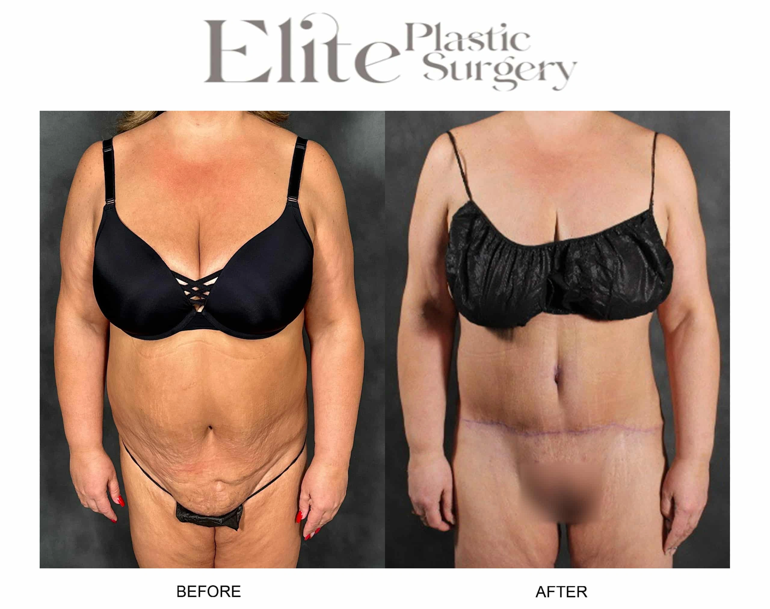 Real patient results before and after plastic surgery results in Arizona, performed by Dr. Torabi