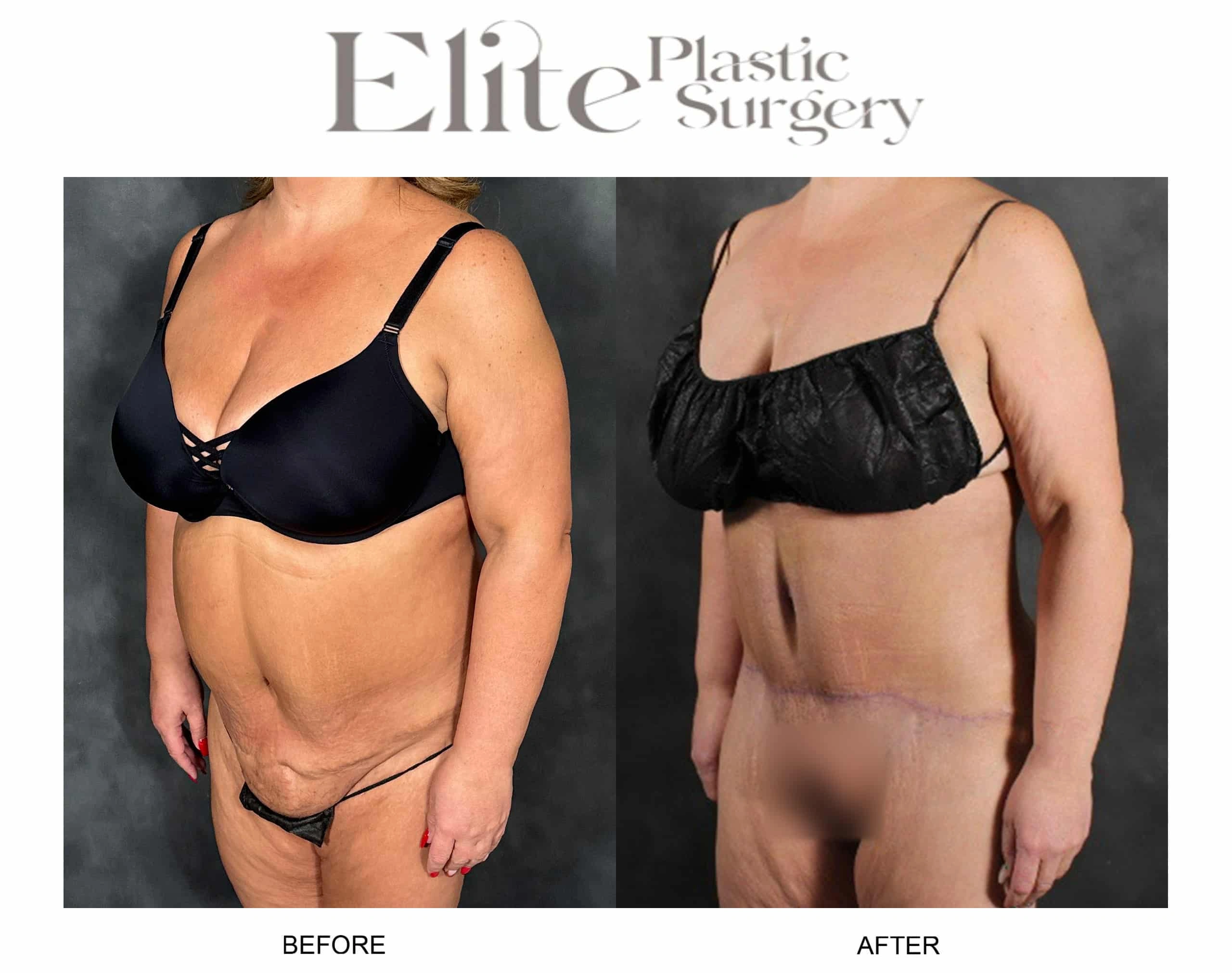 Real patient results before and after plastic surgery results in Arizona, performed by Dr. Torabi