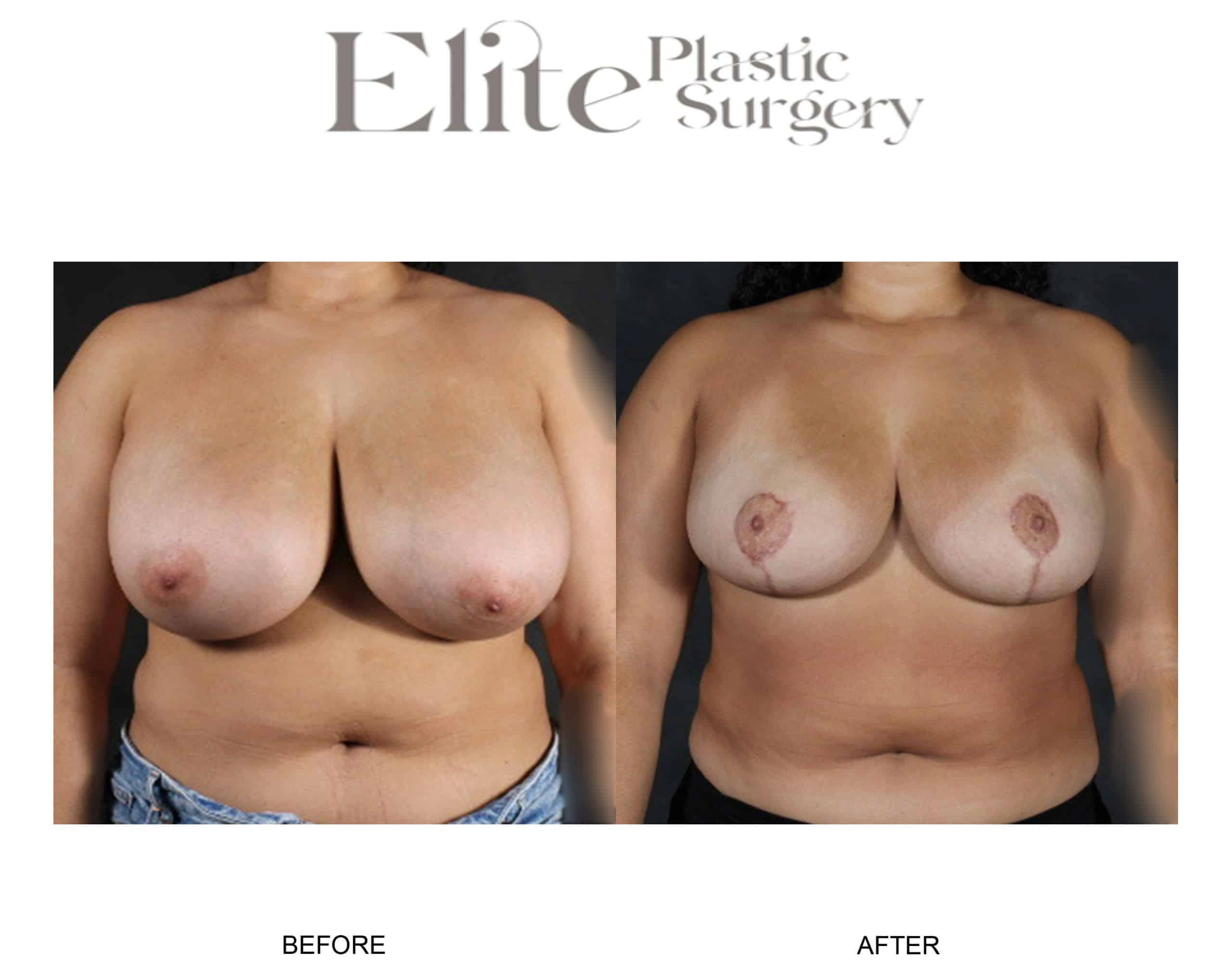 Real patient results before and after plastic surgery results in Arizona, performed by Dr. Torabi