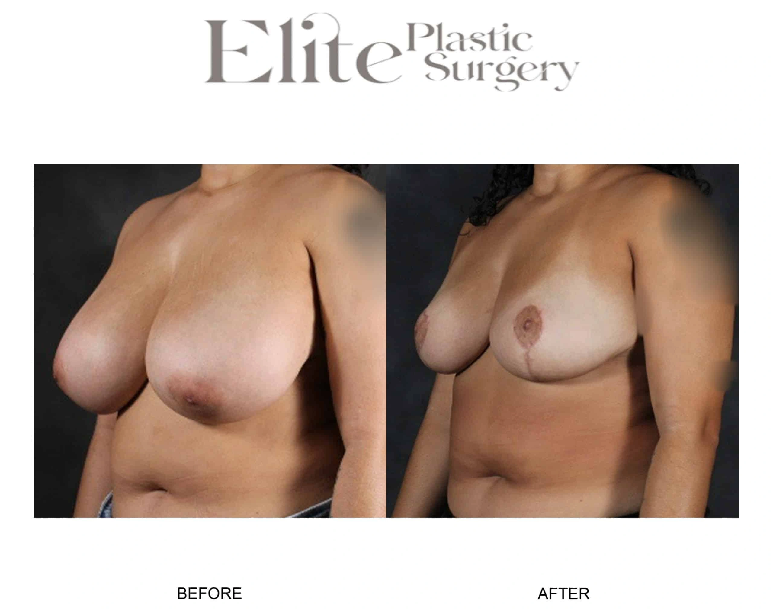 Real patient results before and after plastic surgery results in Arizona, performed by Dr. Torabi