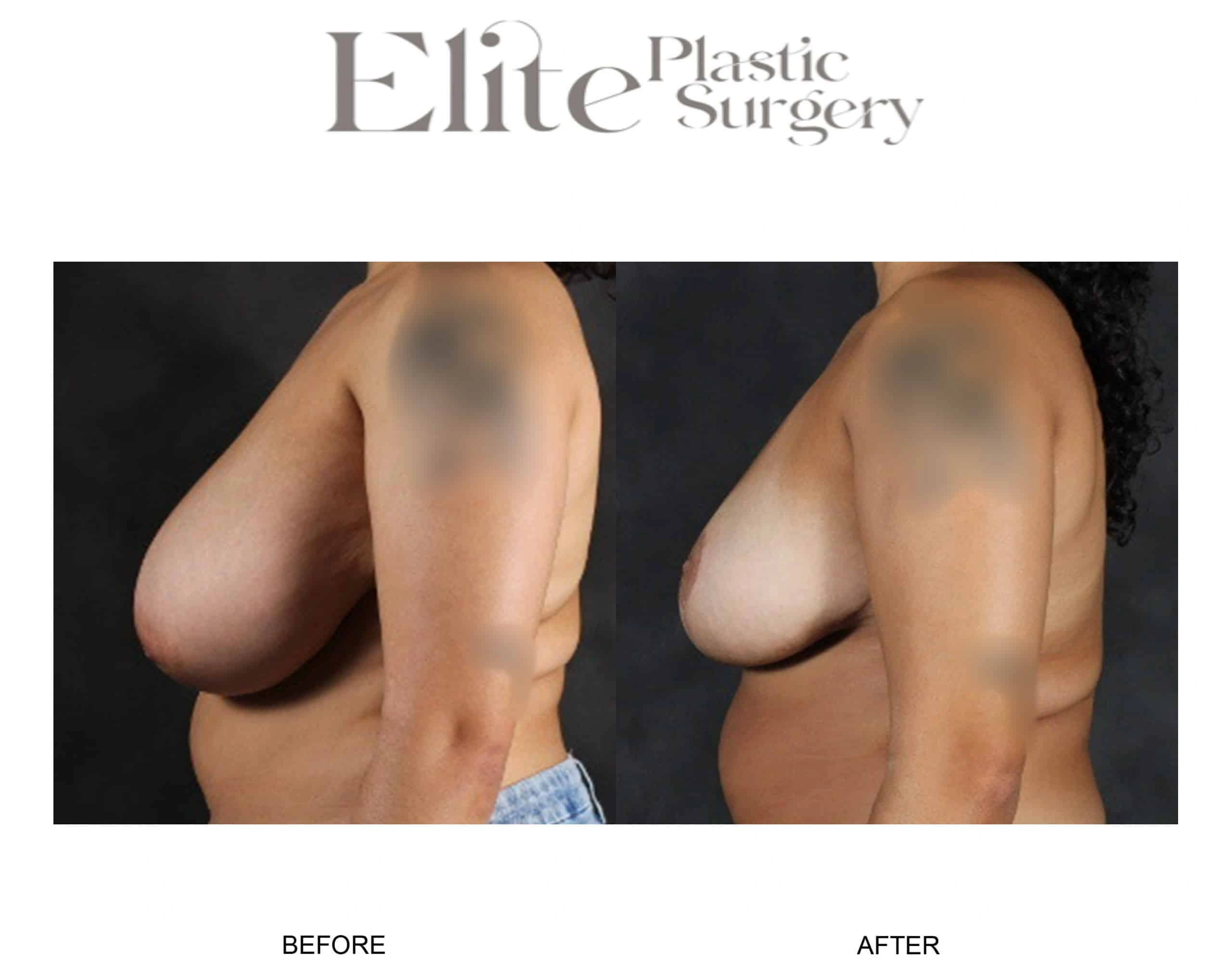 Real patient results before and after plastic surgery results in Arizona, performed by Dr. Torabi
