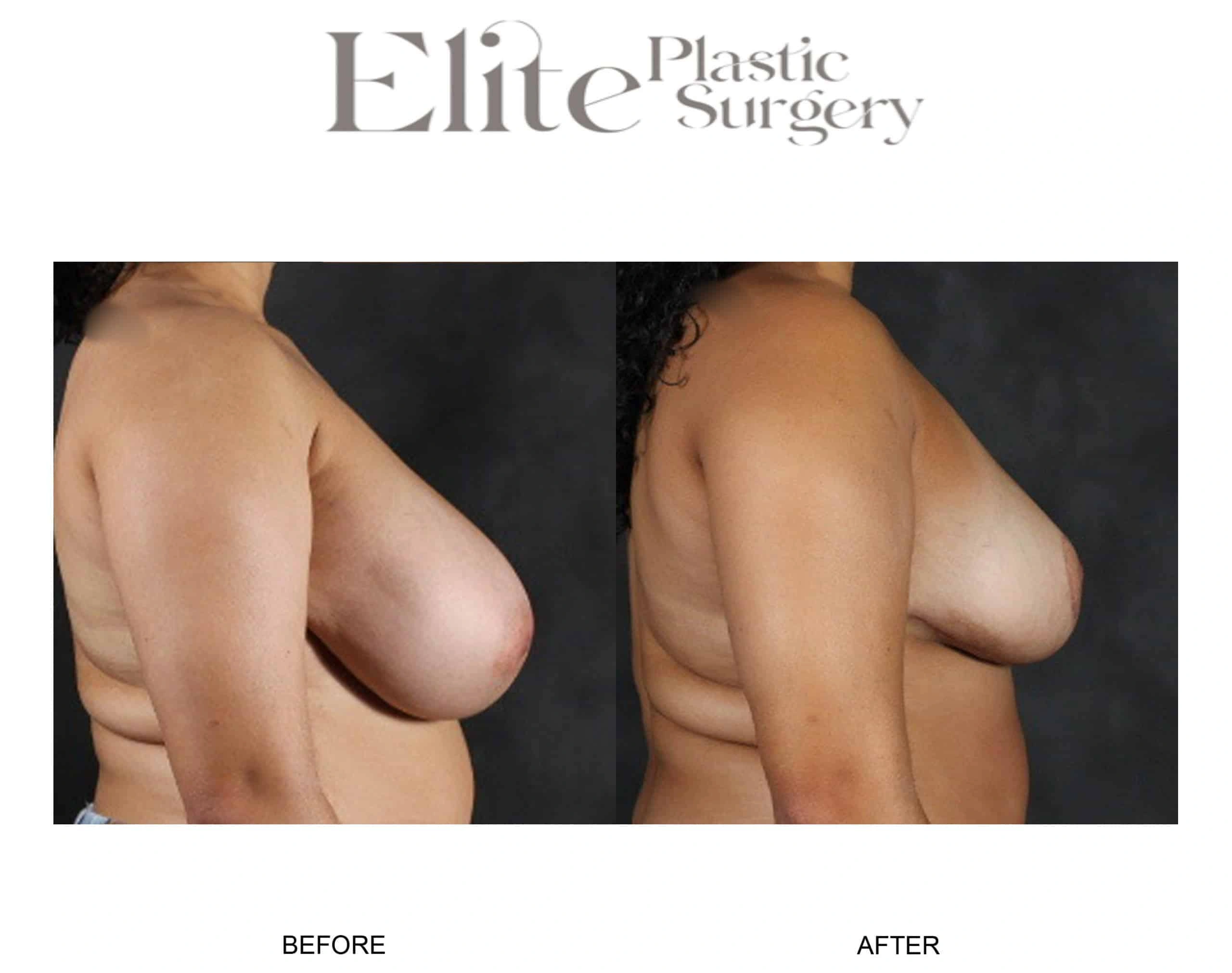 Real patient results before and after plastic surgery results in Arizona, performed by Dr. Torabi