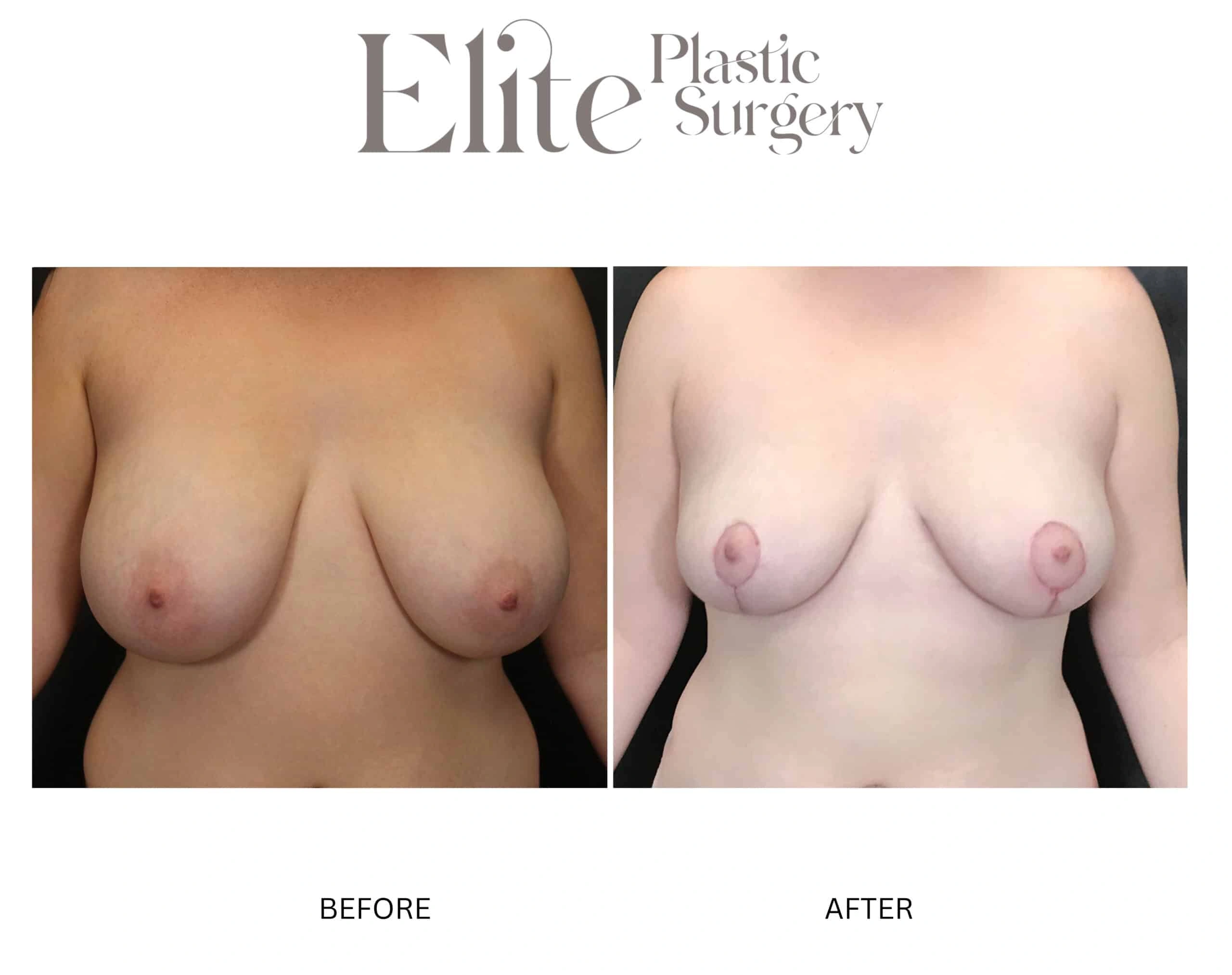 Real patient results before and after plastic surgery results in Arizona, performed by Dr. Torabi