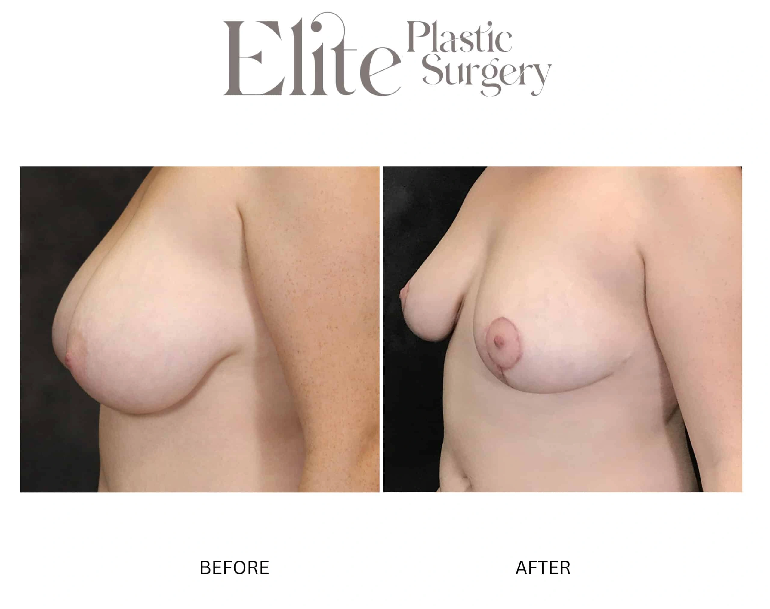 Real patient results before and after plastic surgery results in Arizona, performed by Dr. Torabi