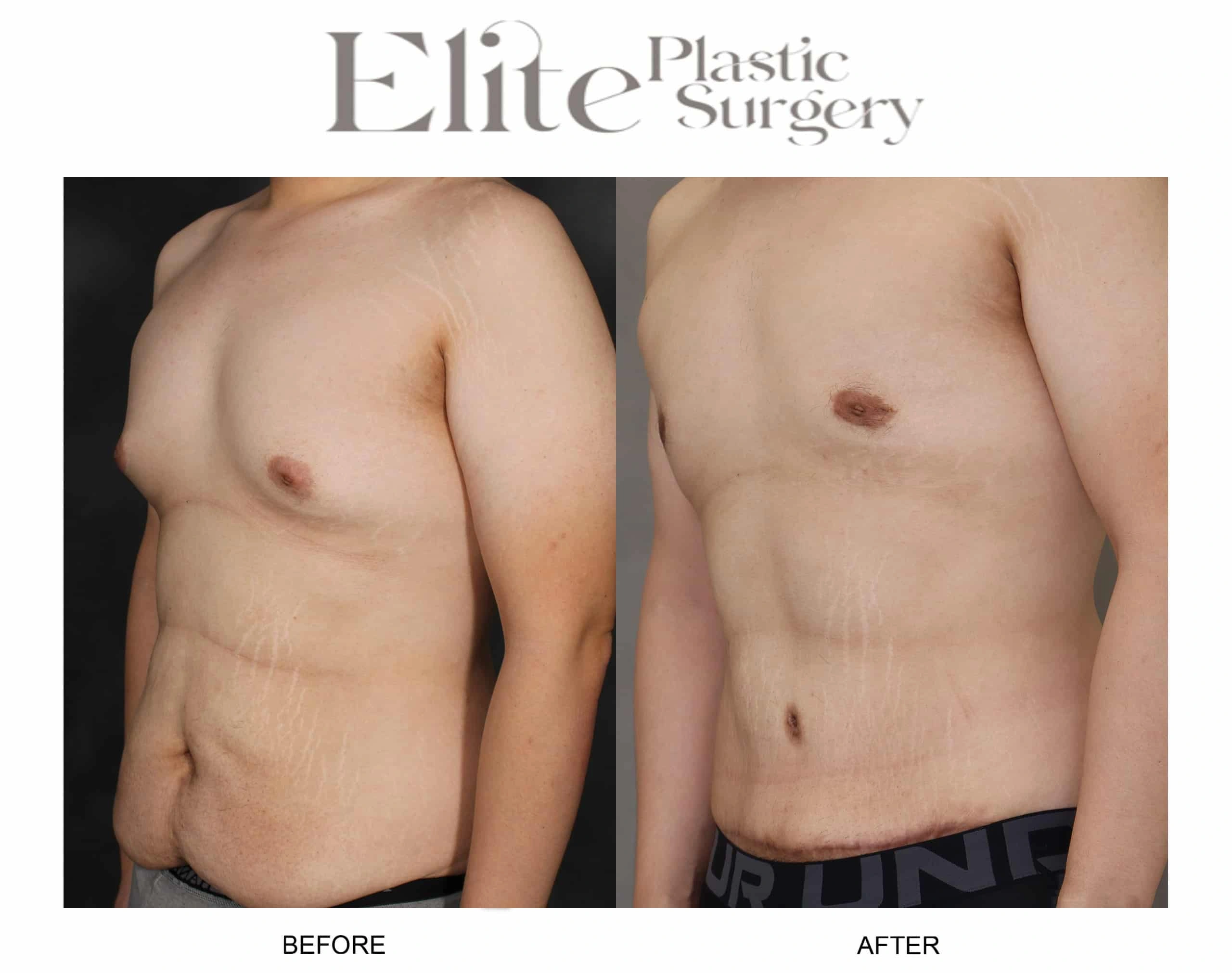 Real patient results before and after plastic surgery results in Arizona, performed by Dr. Torabi