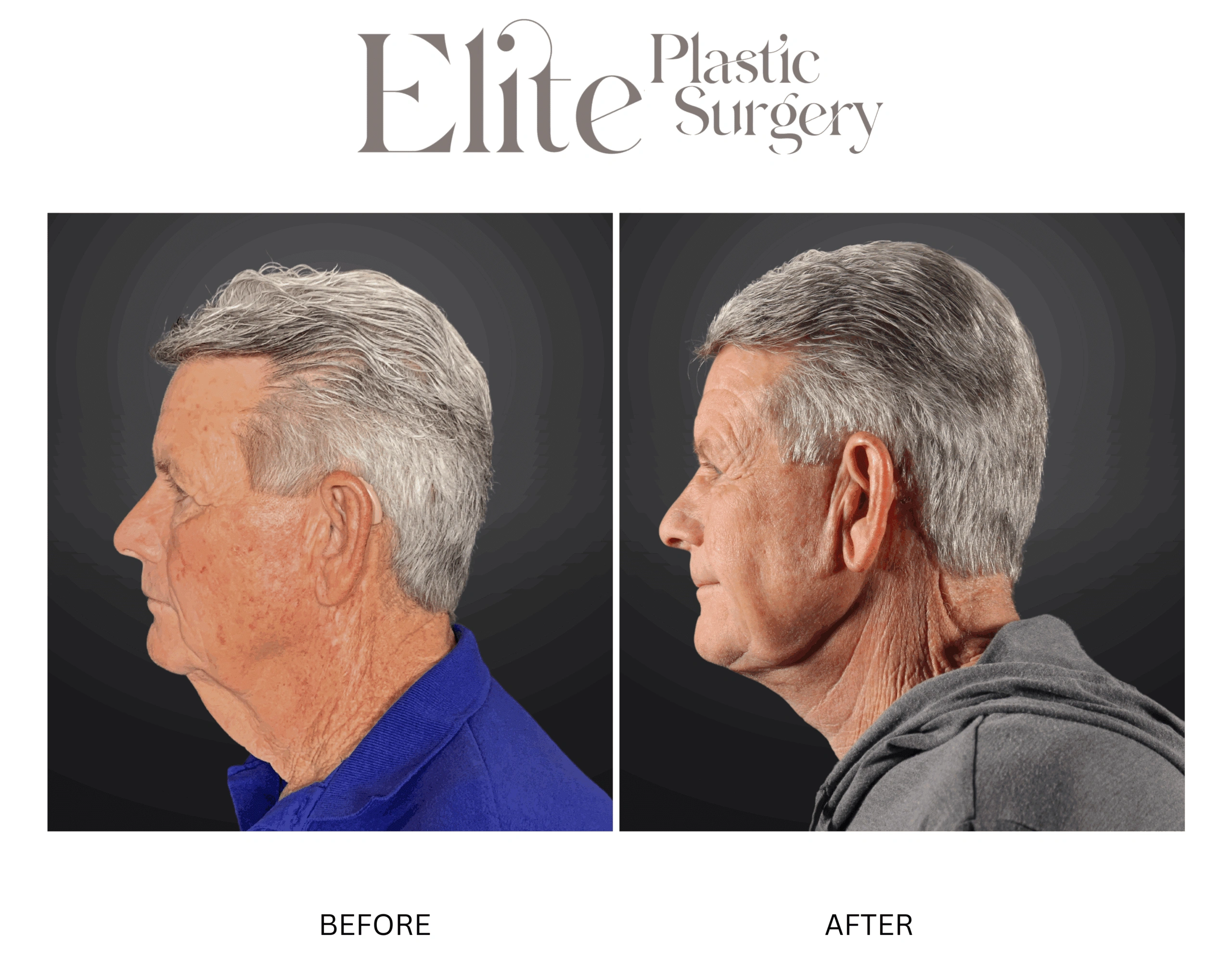 Real patient results before and after plastic surgery results in Arizona, performed by Dr. Torabi