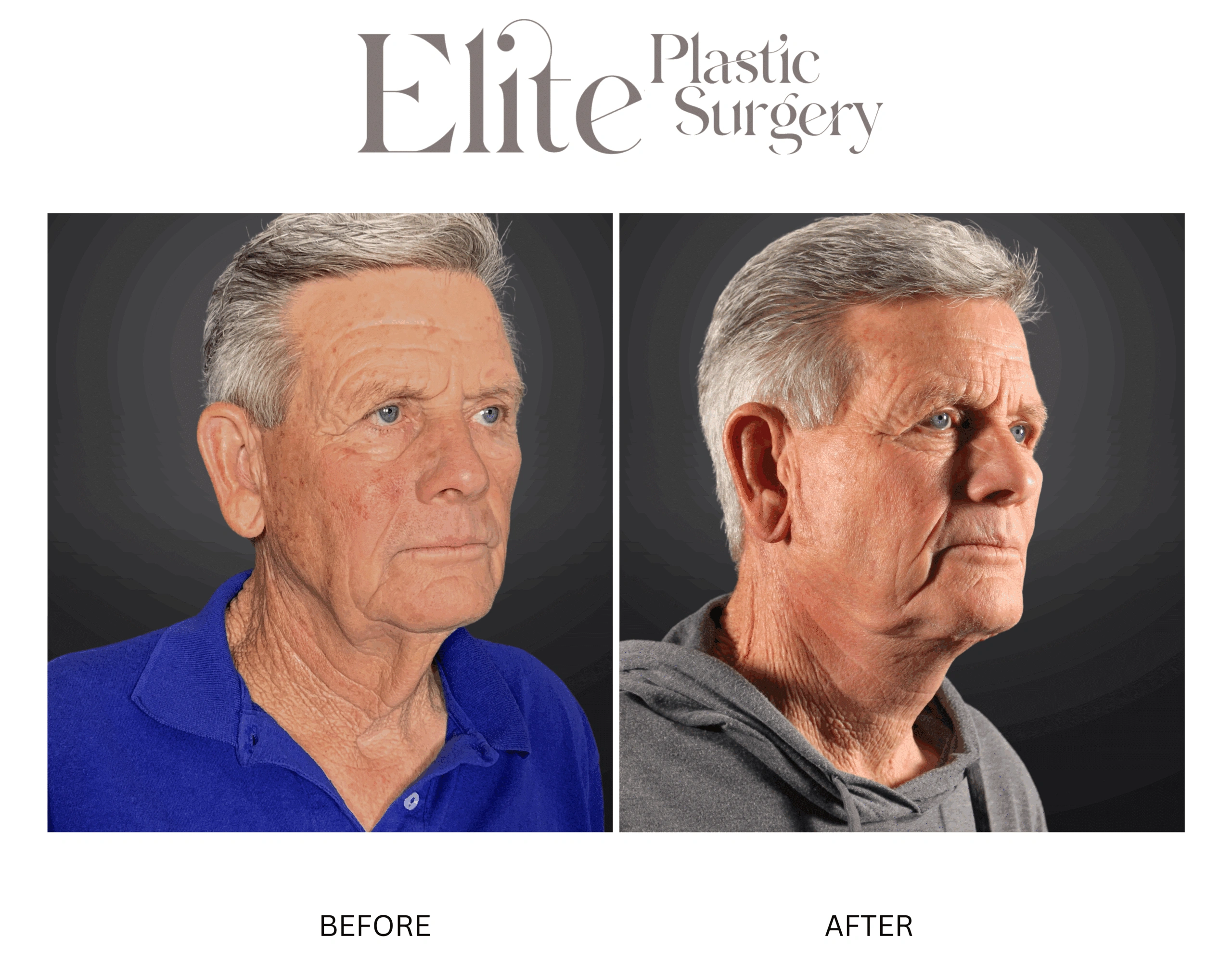Real patient results before and after plastic surgery results in Arizona, performed by Dr. Torabi