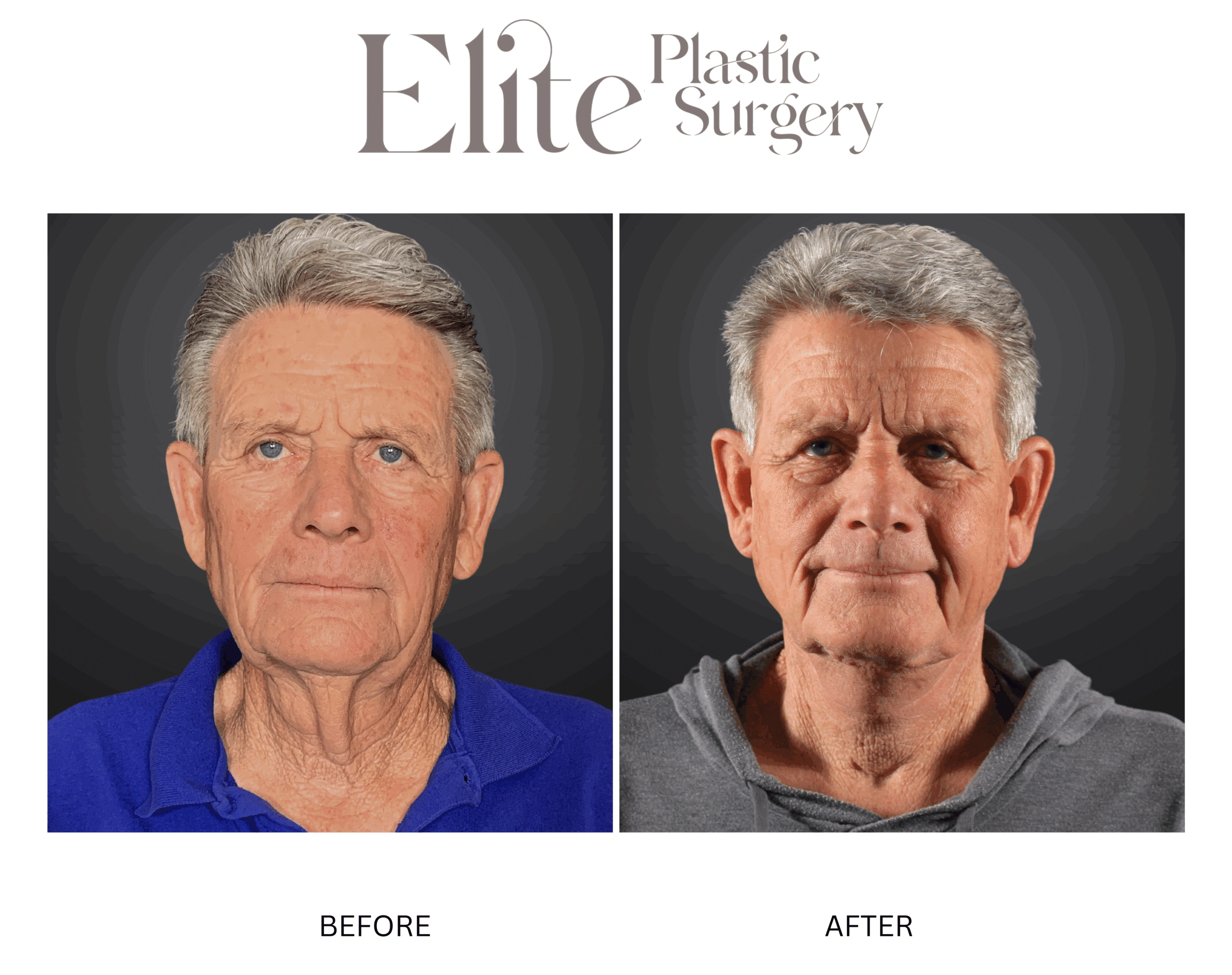 Real patient results before and after plastic surgery results in Arizona, performed by Dr. Torabi