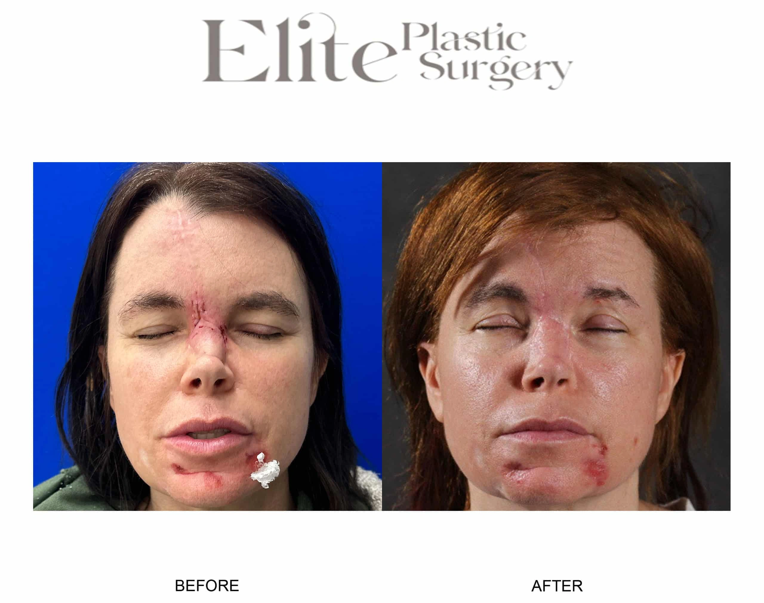 Real patient results before and after plastic surgery results in Arizona, performed by Dr. Torabi