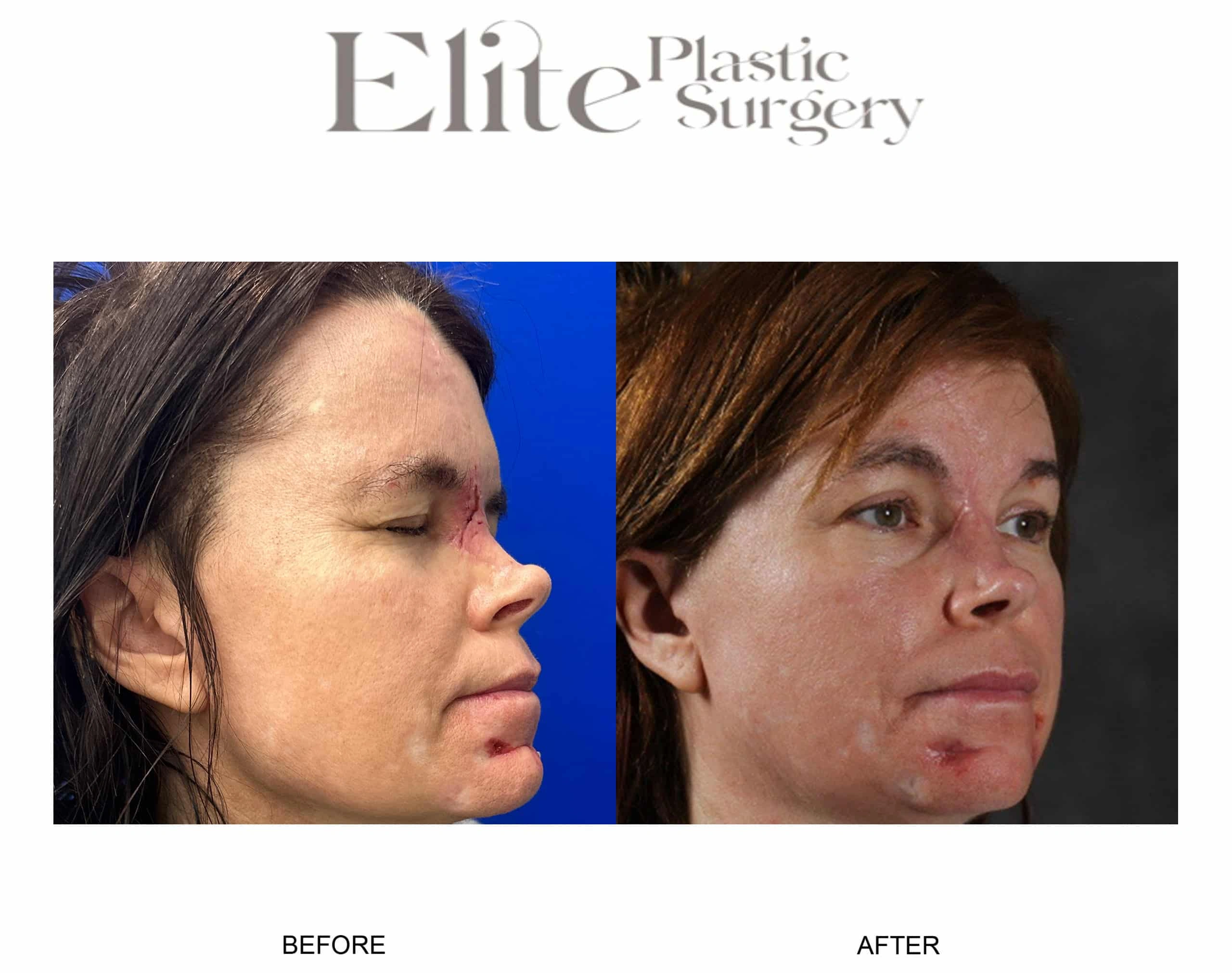 Real patient results before and after plastic surgery results in Arizona, performed by Dr. Torabi