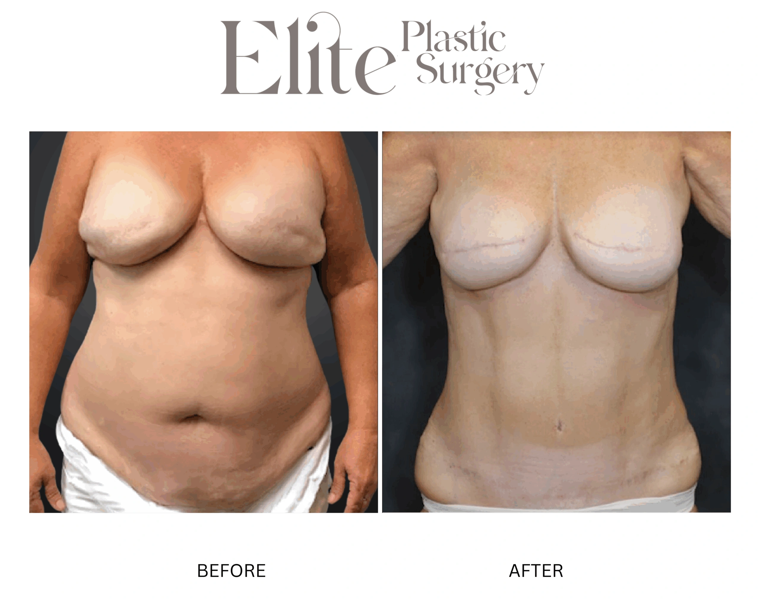 Real patient results before and after plastic surgery results in Arizona, performed by Dr. Torabi
