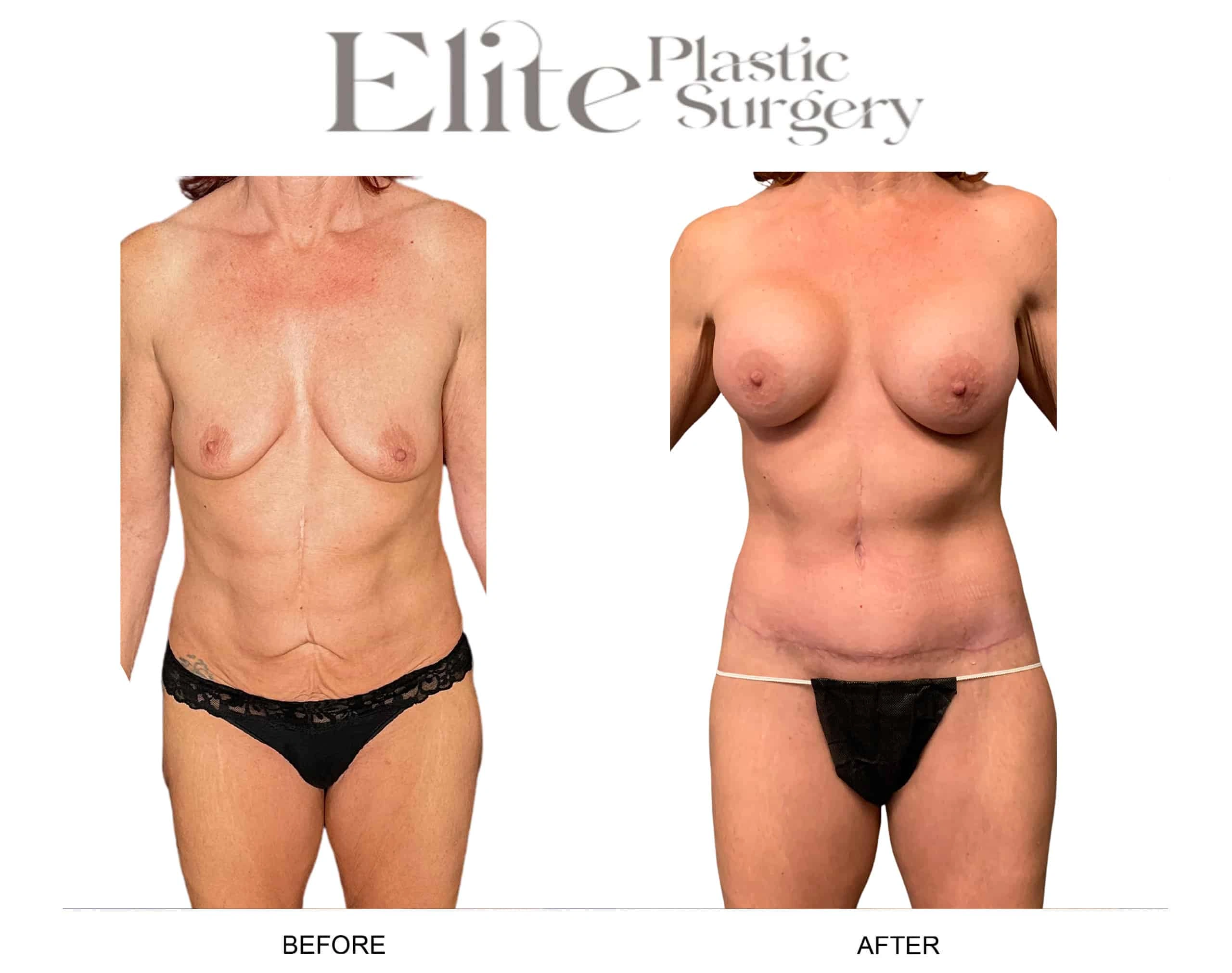 Real patient results before and after plastic surgery results in Arizona, performed by Dr. Torabi