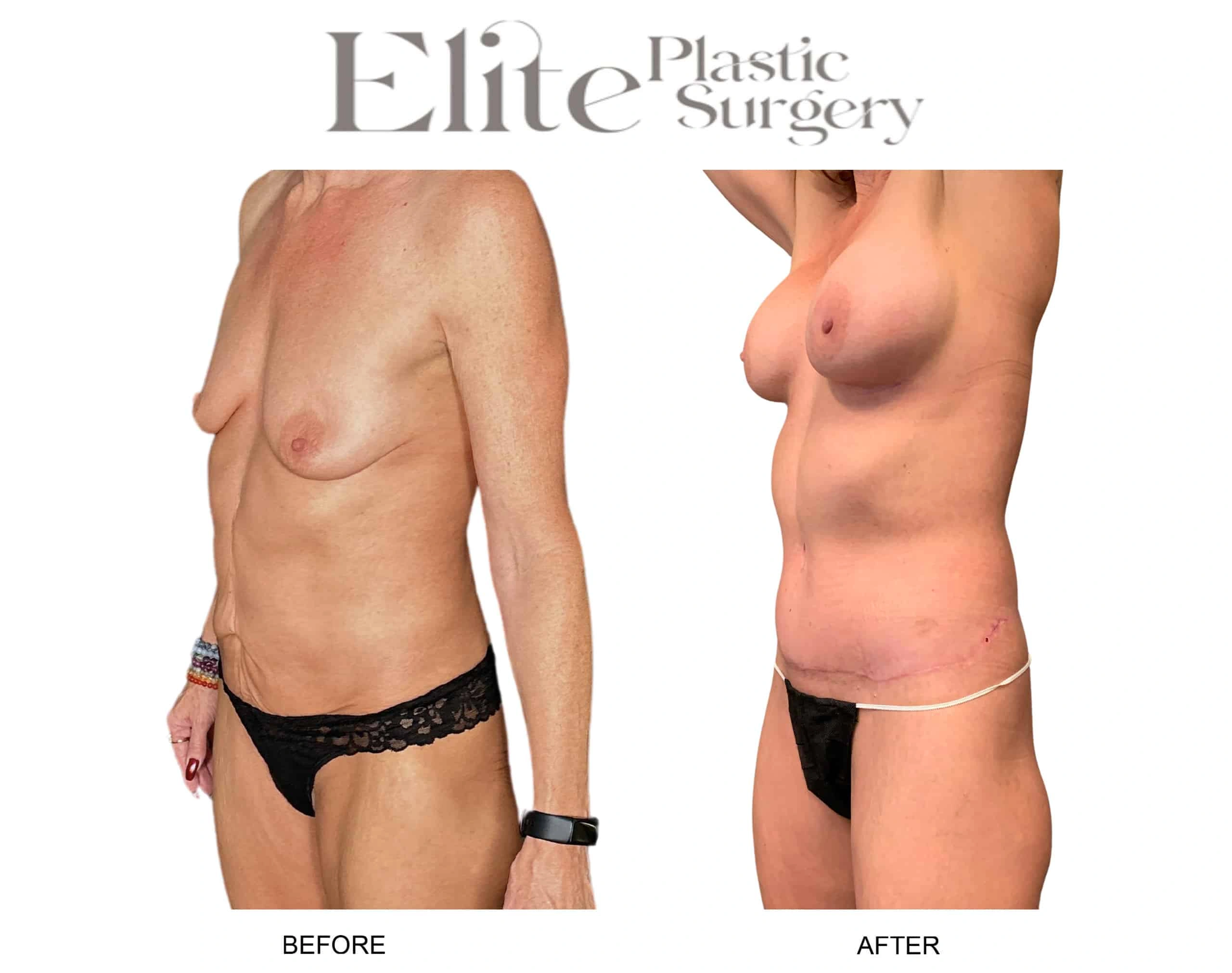 Real patient results before and after plastic surgery results in Arizona, performed by Dr. Torabi