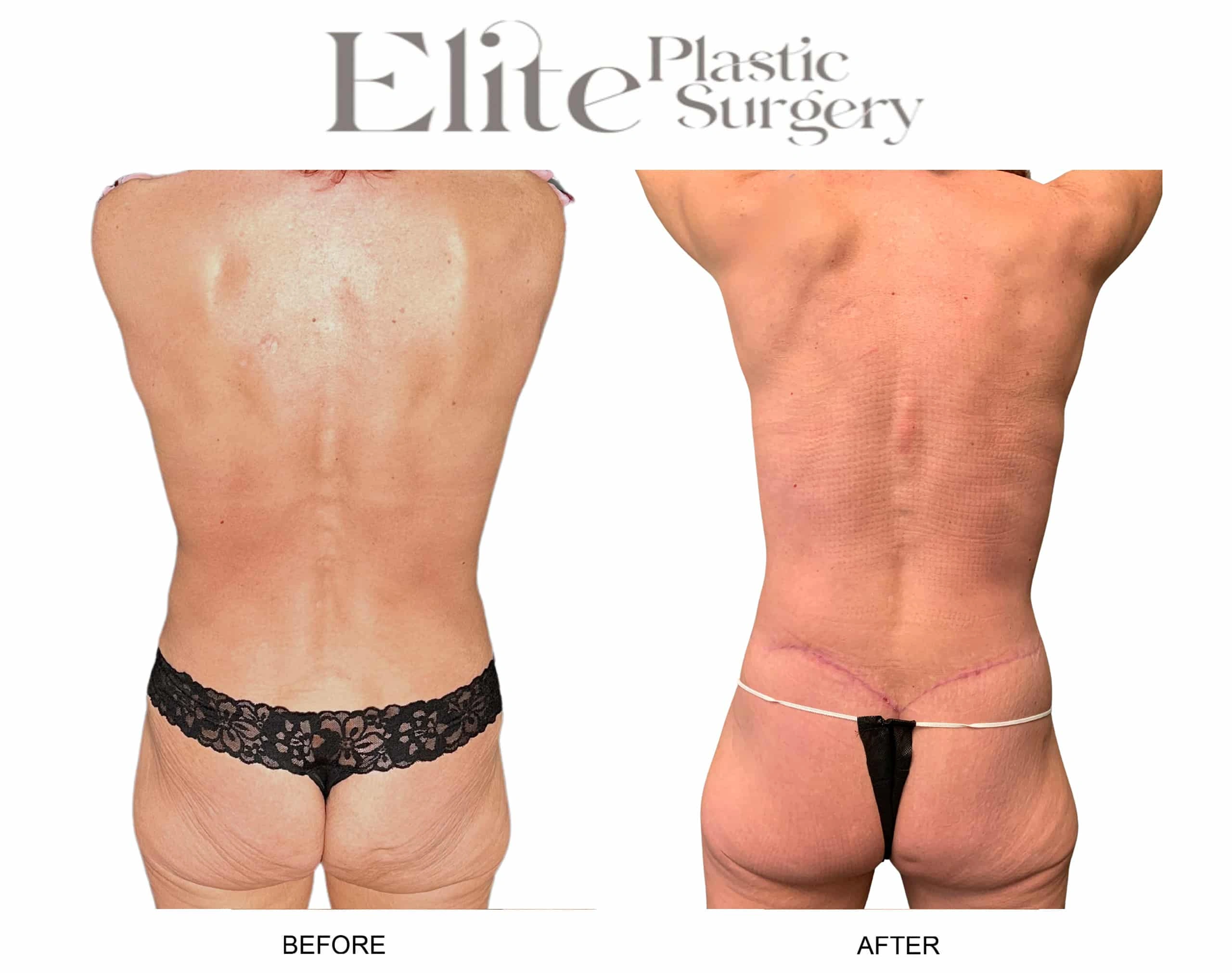 Real patient results before and after plastic surgery results in Arizona, performed by Dr. Torabi