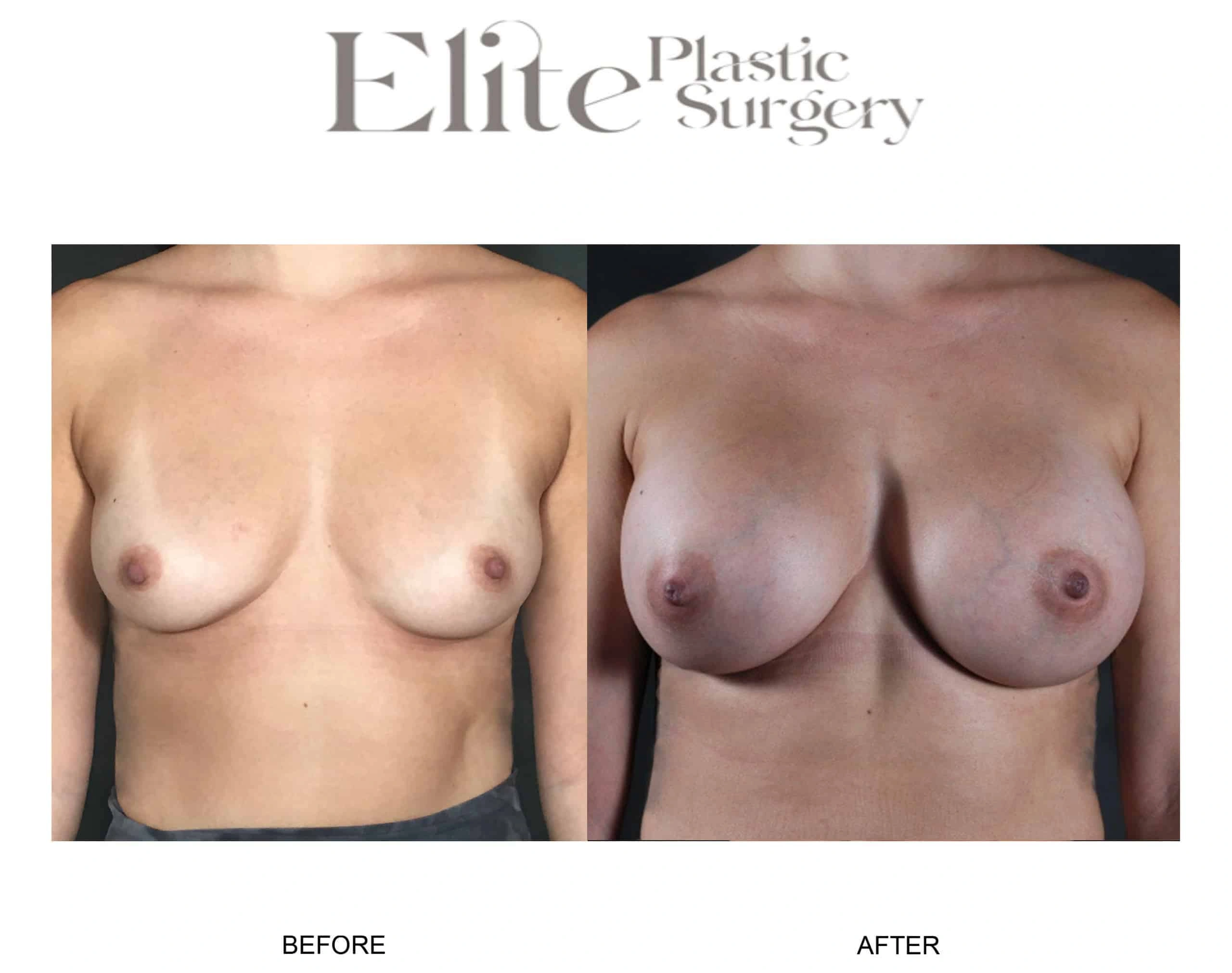 Real patient results before and after plastic surgery results in Arizona, performed by Dr. Torabi