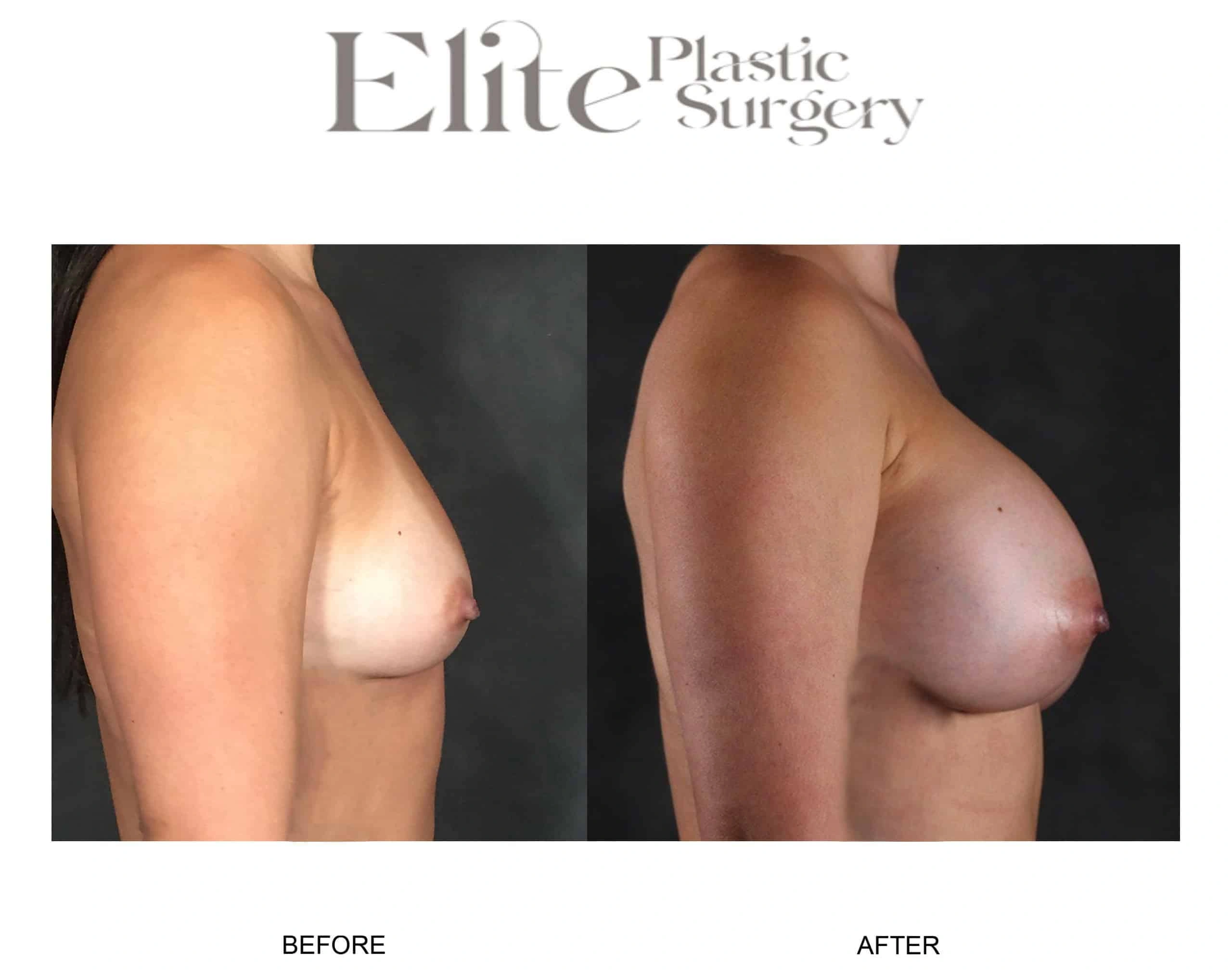 Real patient results before and after plastic surgery results in Arizona, performed by Dr. Torabi