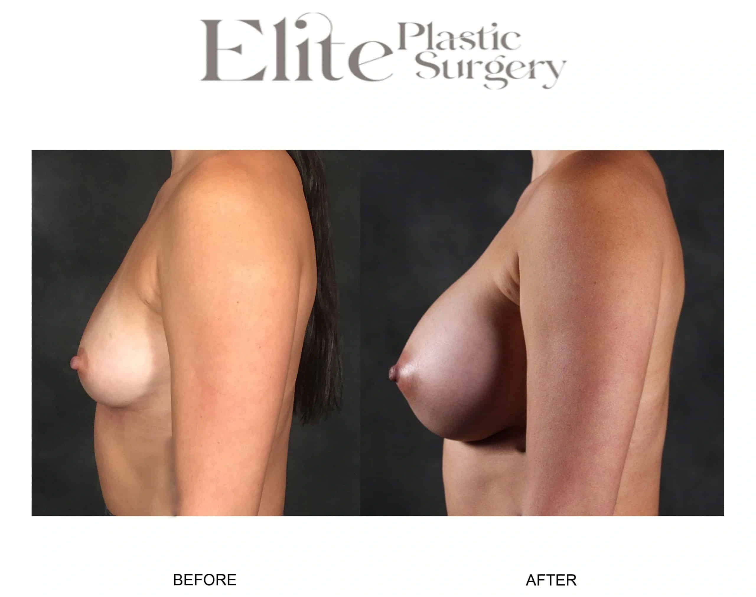 Real patient results before and after plastic surgery results in Arizona, performed by Dr. Torabi